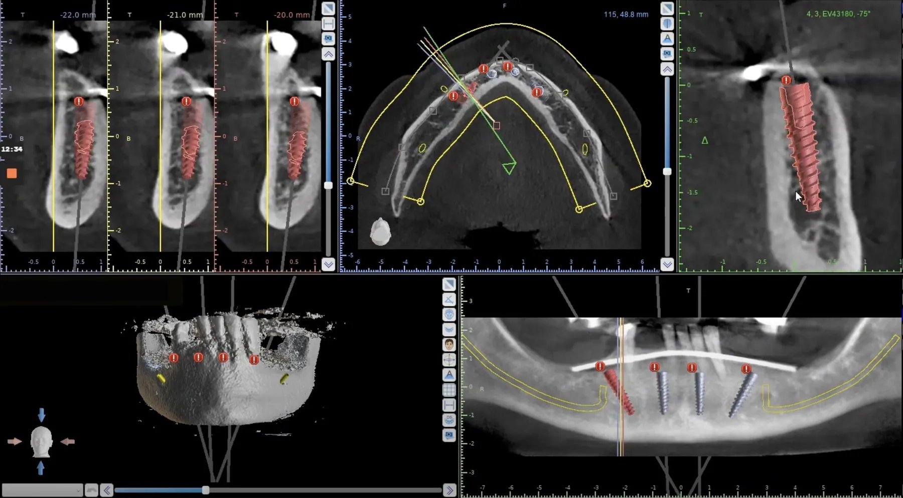 3D planning of implant positions for a full arch on a CT scan, Beverly Hills