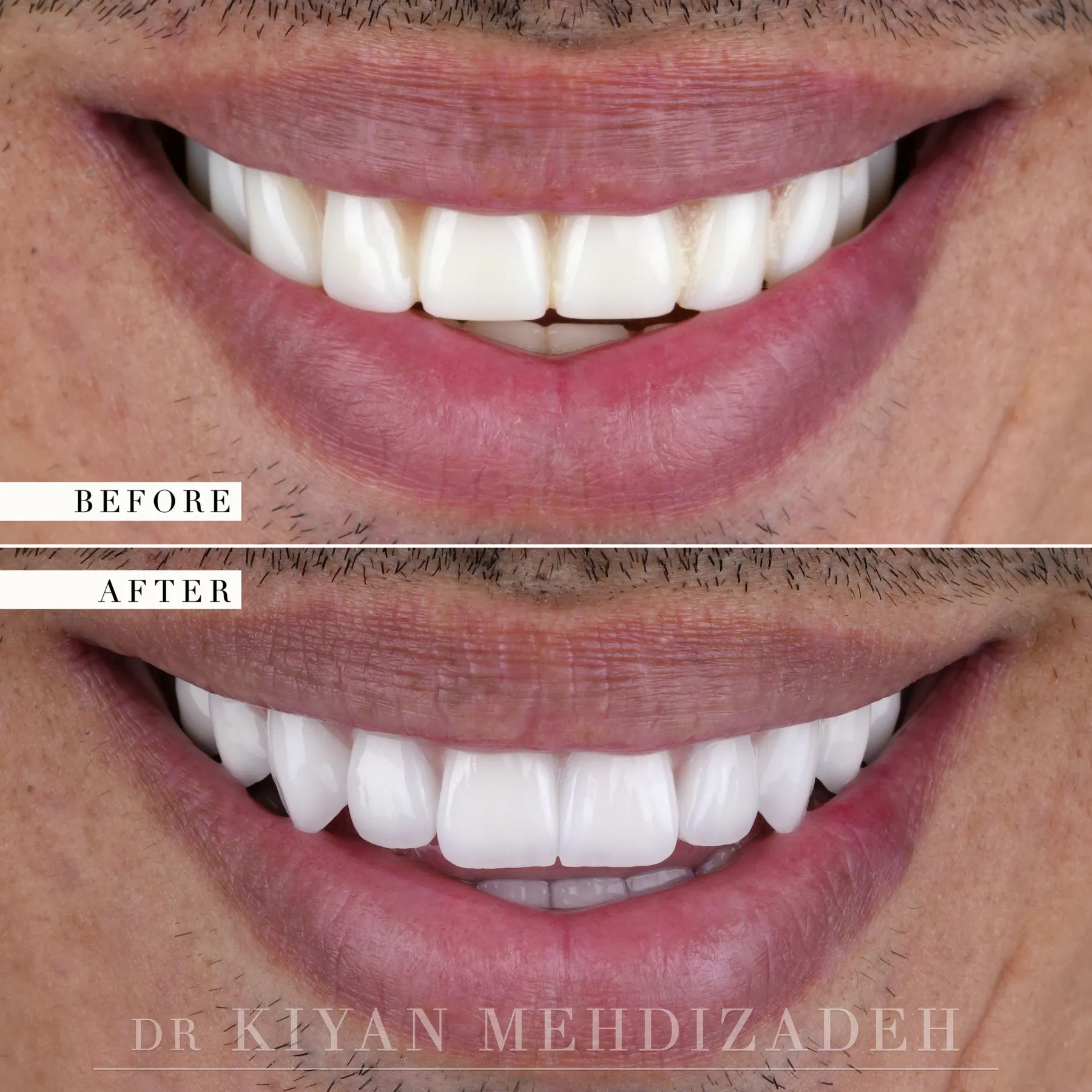 Before and after implant bridges in hand-stacked porcelain - close-up of the smile, Beverly Hills