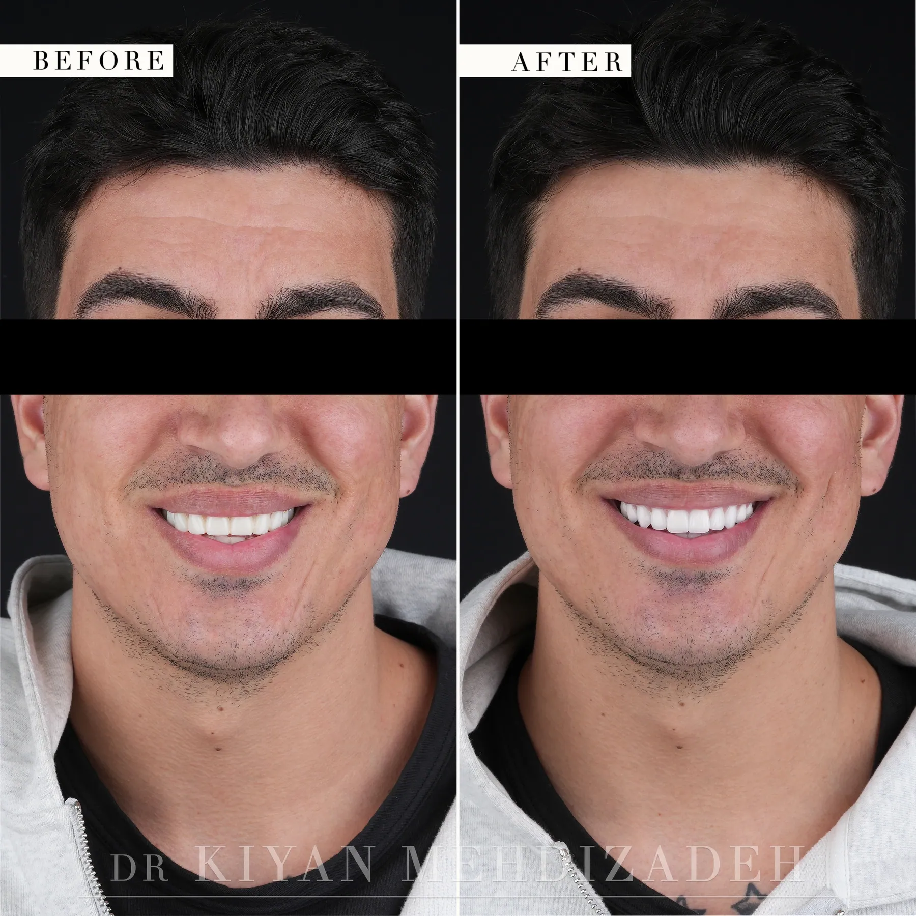 Before and after full-face portrait, eyes redacted - implant bridges in hand-stacked porcelain with pink porcelain gum, Beverly Hills