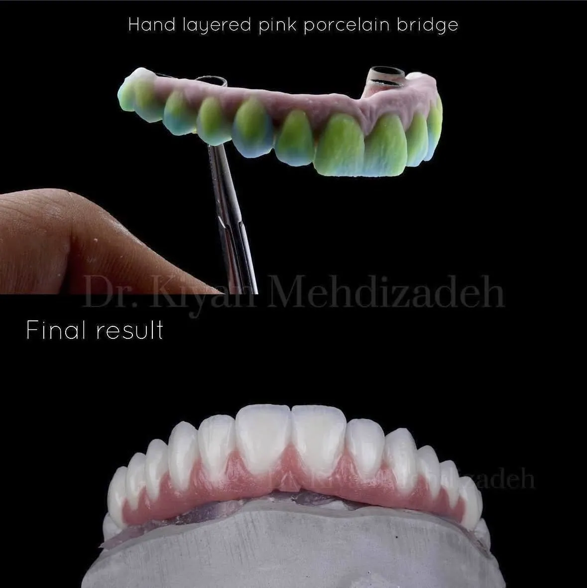A finished hand-layered bridge with pink porcelain, in our laboratory