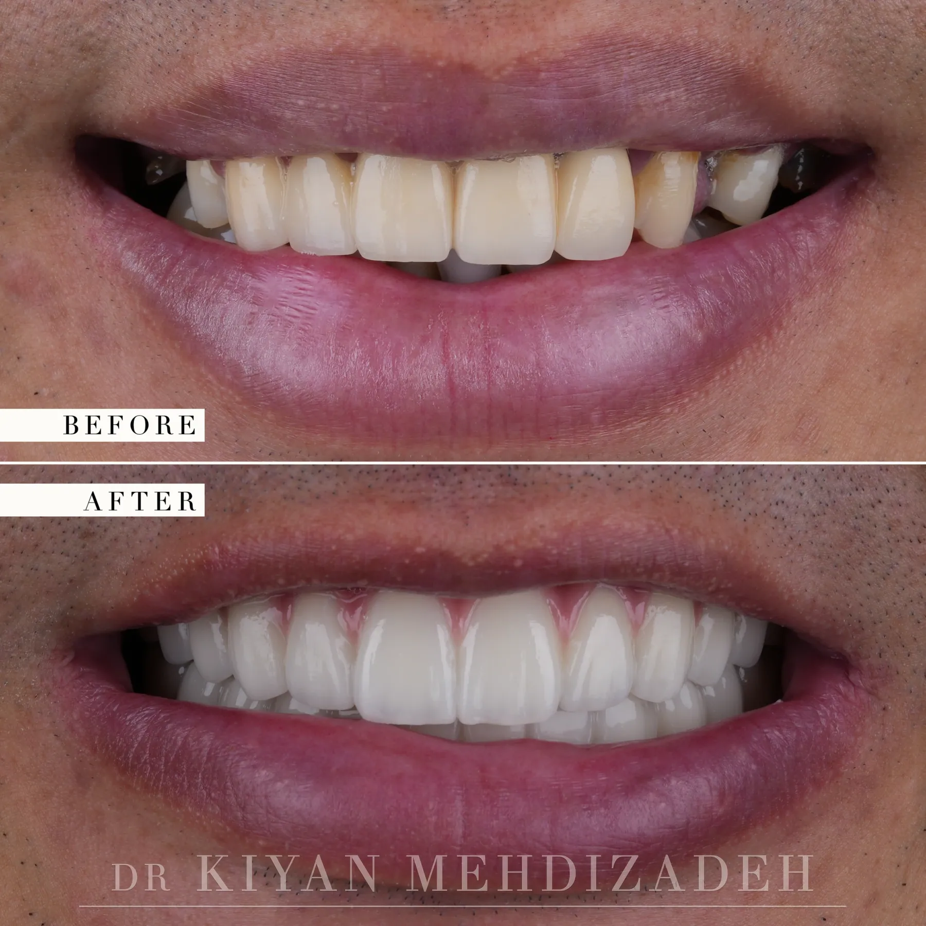 All-on-4 implant-supported bridges before and after &mdash; Case Study 13