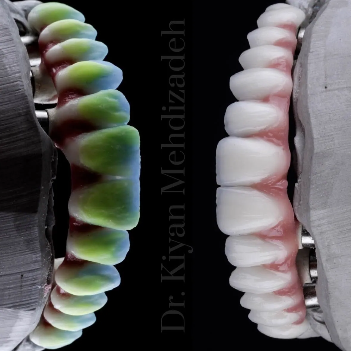 A full-arch bridge being built up in layers of porcelain in our laboratory