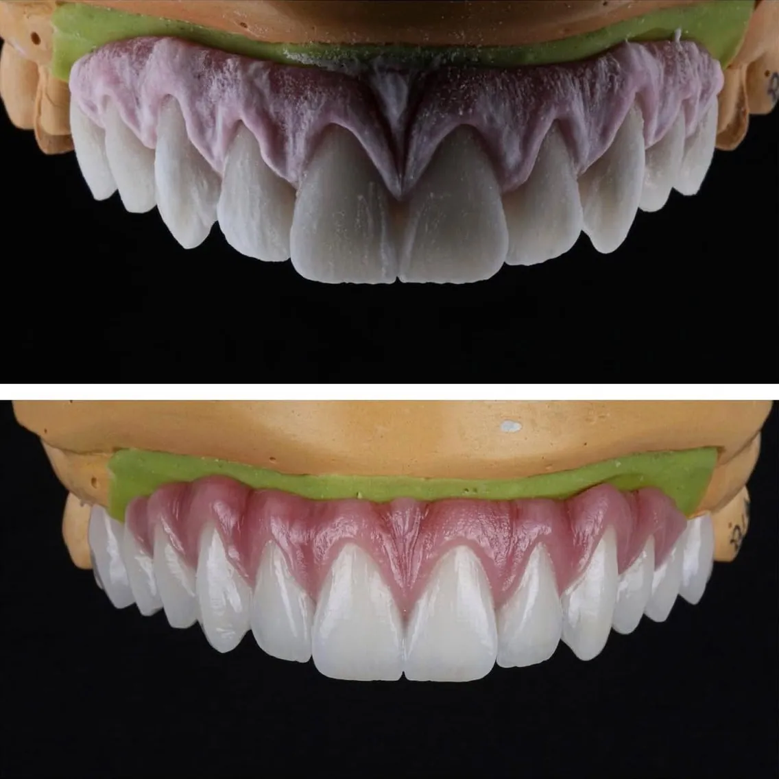 A full-arch bridge in porcelain with pink porcelain replacing the gum line, on the laboratory model