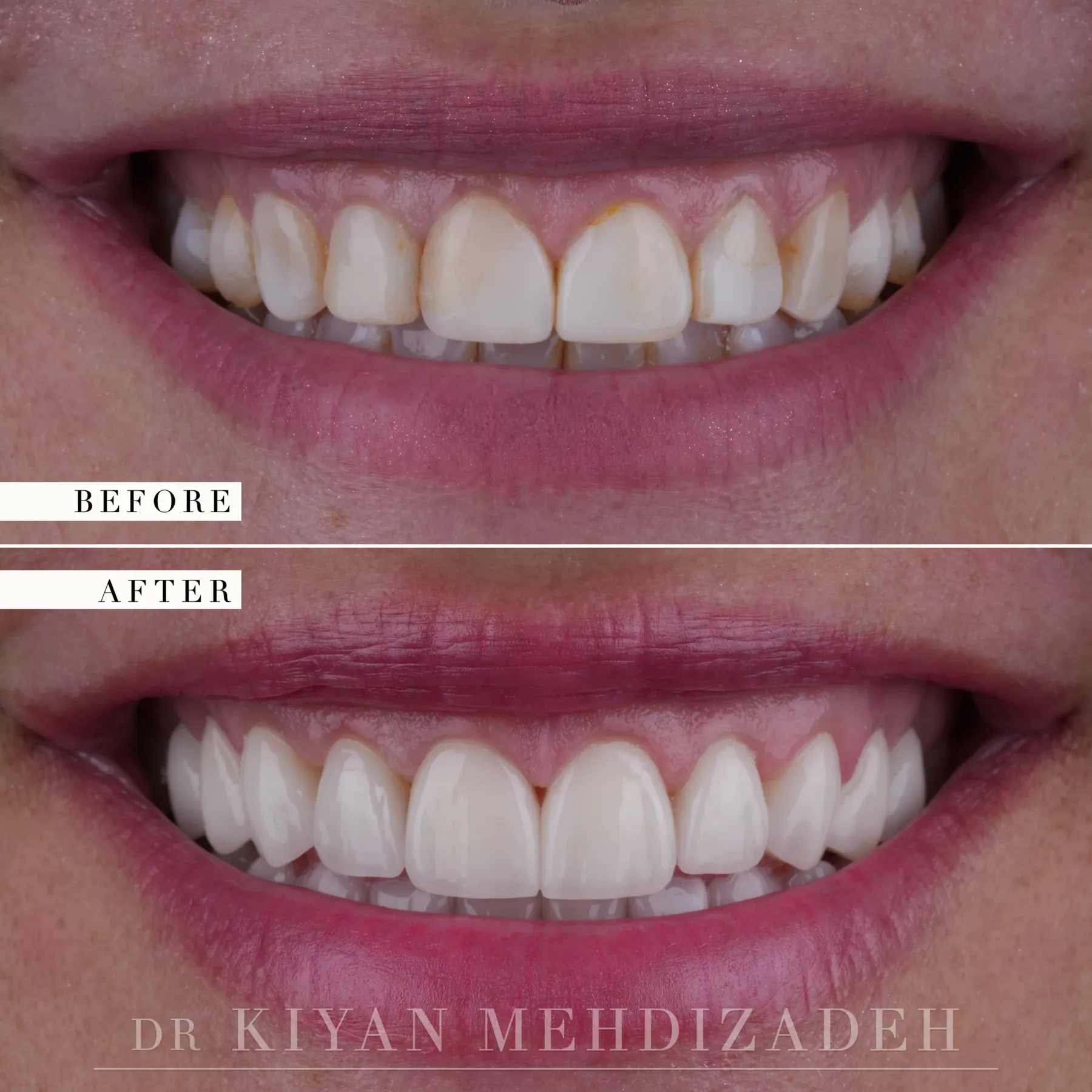 Close-up before and after, discolored bonding replaced with porcelain veneers