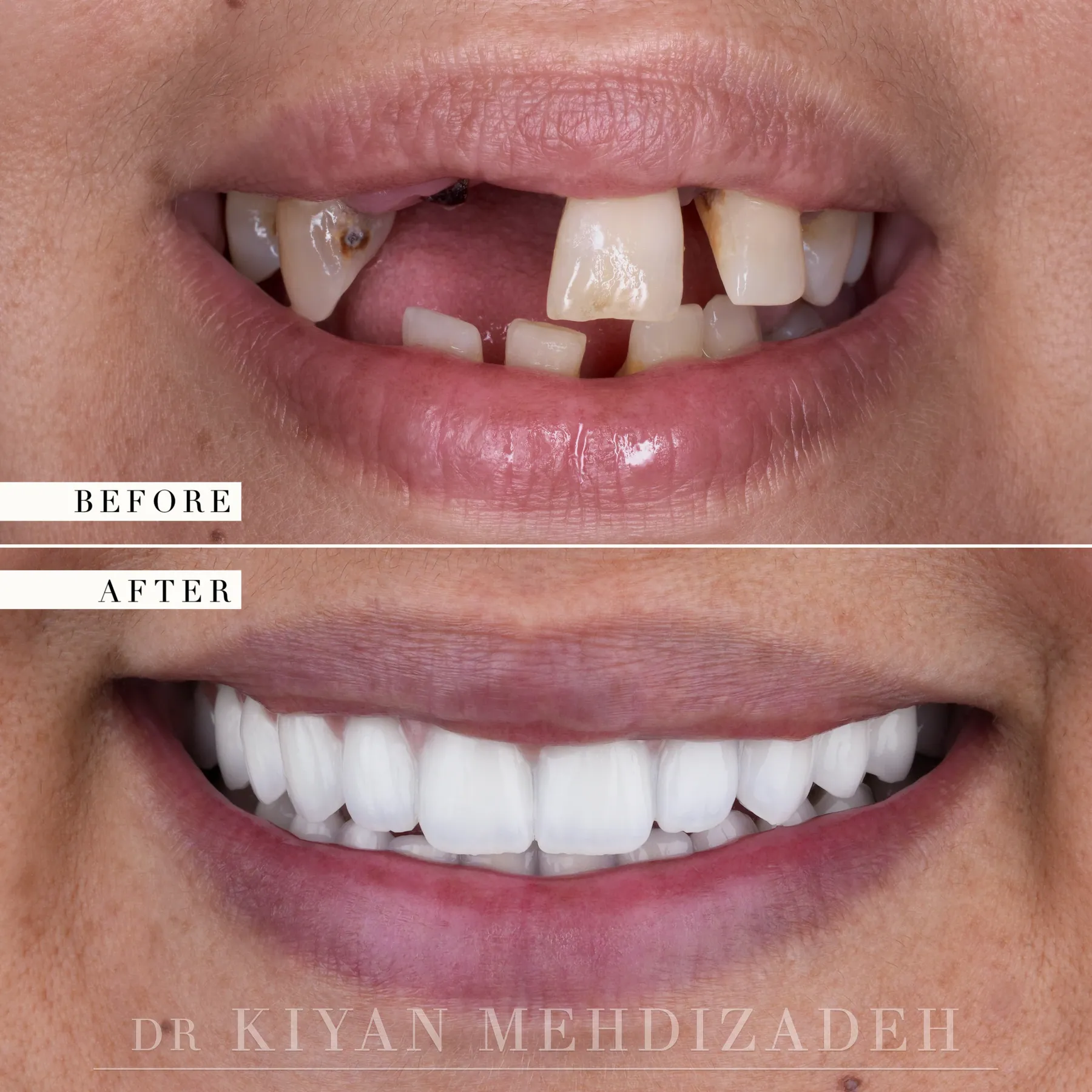 Before and after upper and lower implant-supported bridges with pink porcelain - close-up of the smile, Beverly Hills