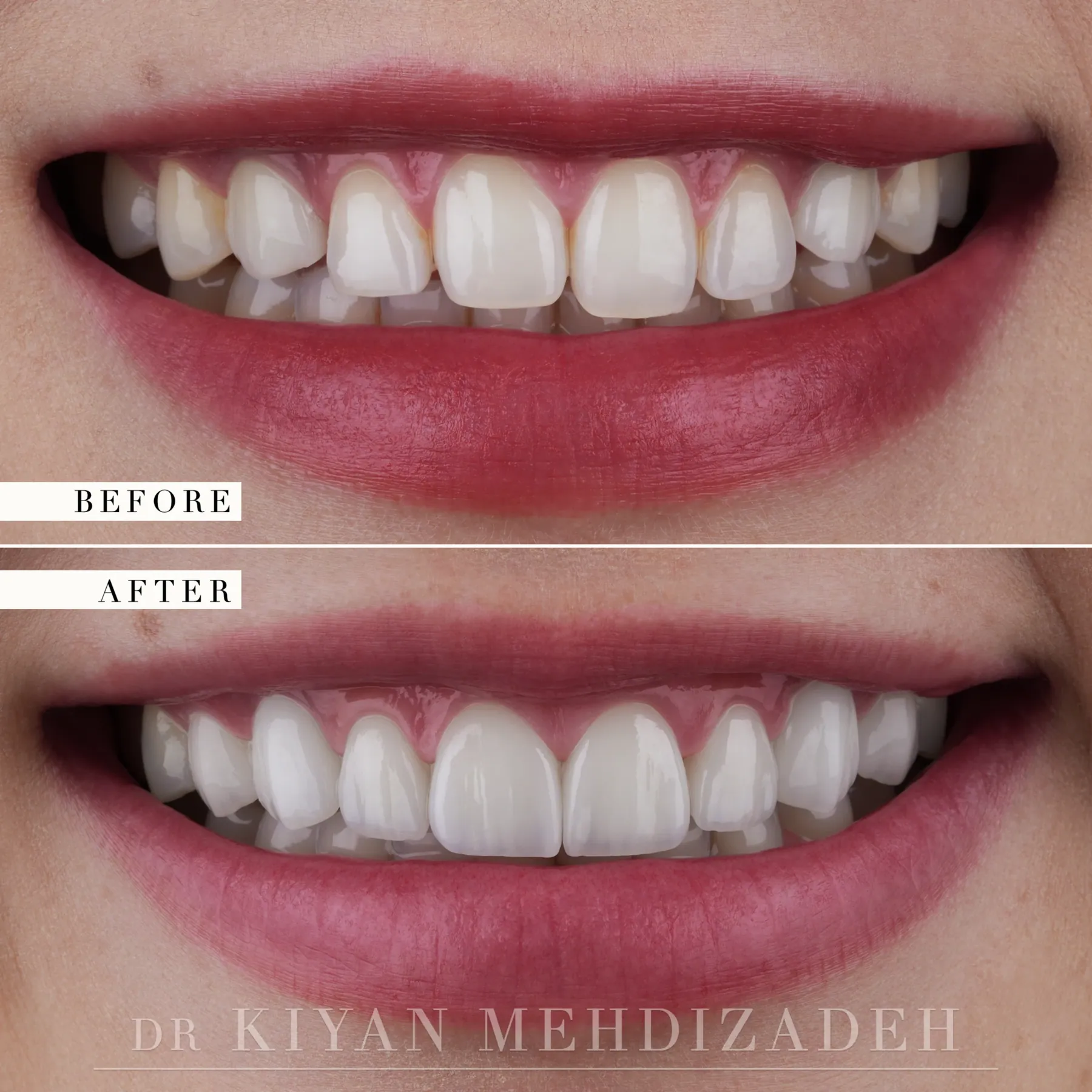 Before and after gum lift and porcelain veneers - frontal close-up smile