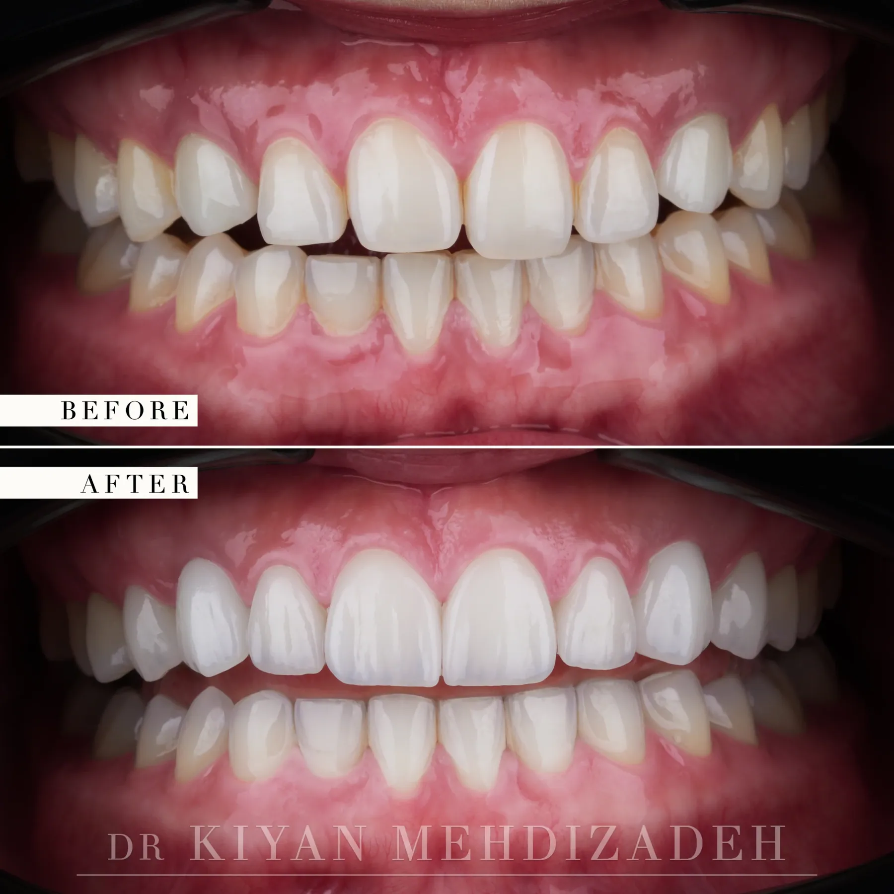 Before and after retracted view of the full arch showing porcelain veneer and implant crown detail