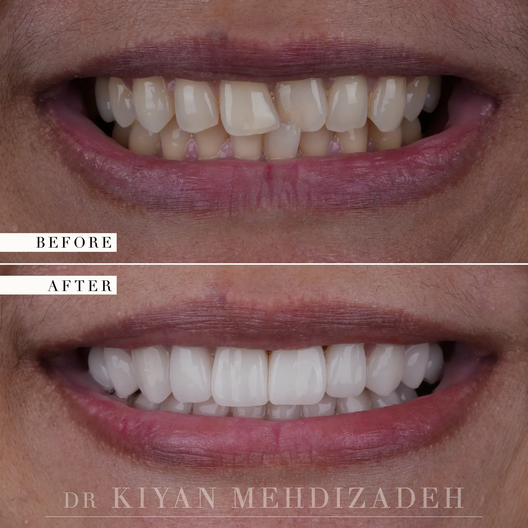 Crossbite correction without braces before and after &mdash; Case Study 08