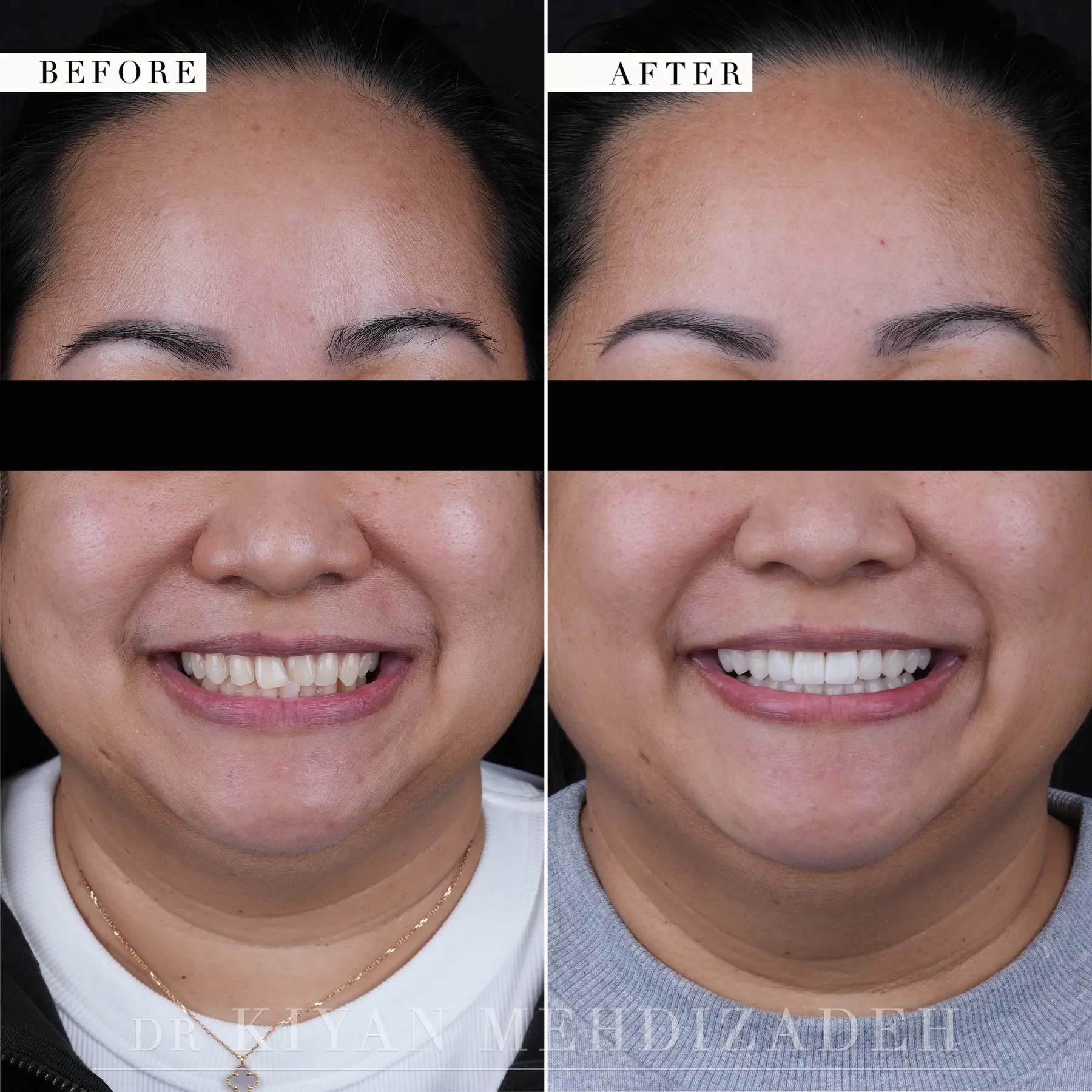Rostro completo, antes y después: mordida cruzada corregida con carillas de porcelana