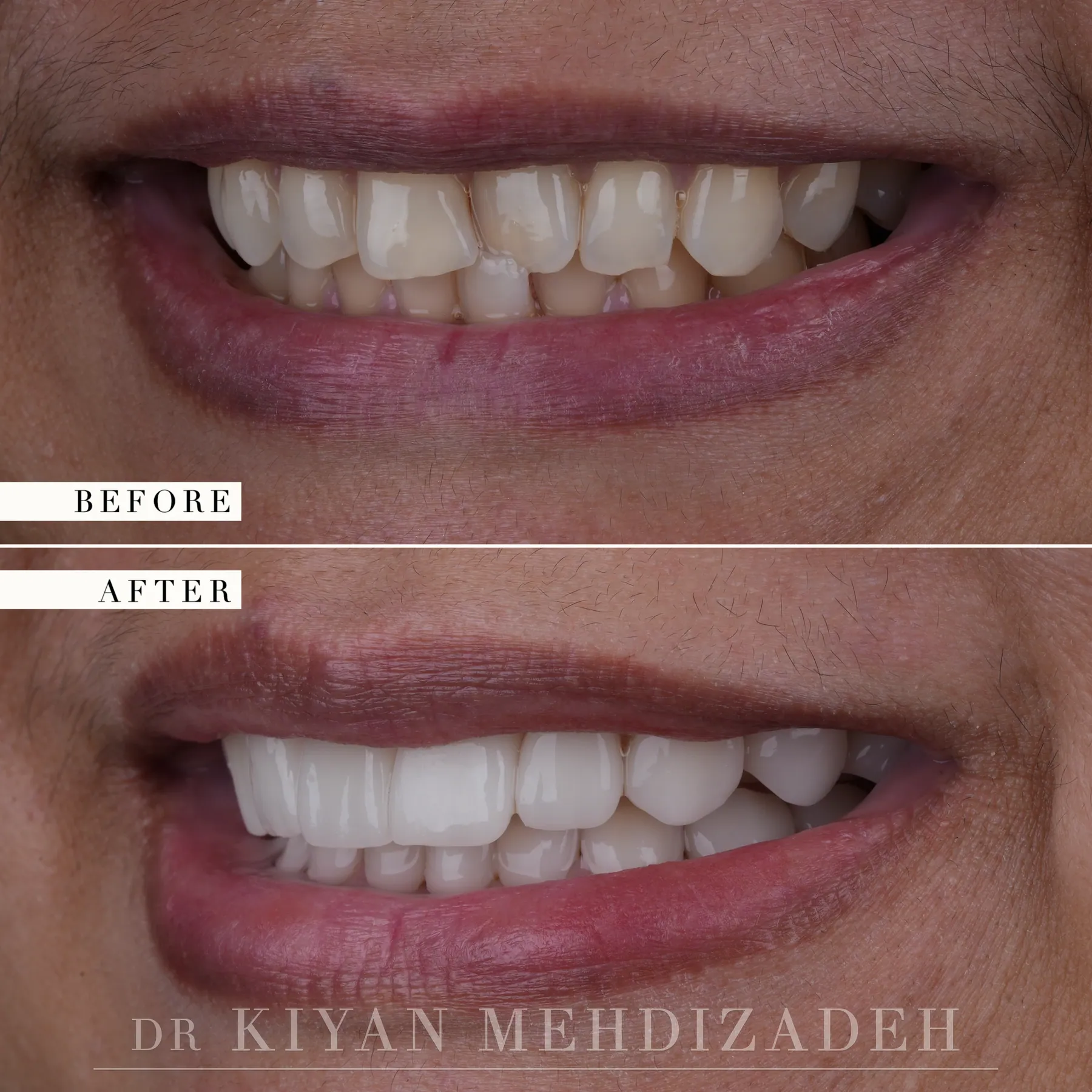 Side view of the smile after a crossbite was corrected with porcelain veneers