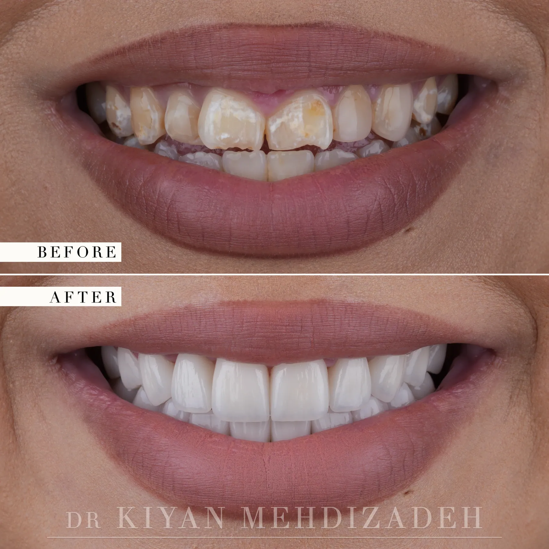 Demineralization treated with porcelain veneers, before and after, Beverly Hills