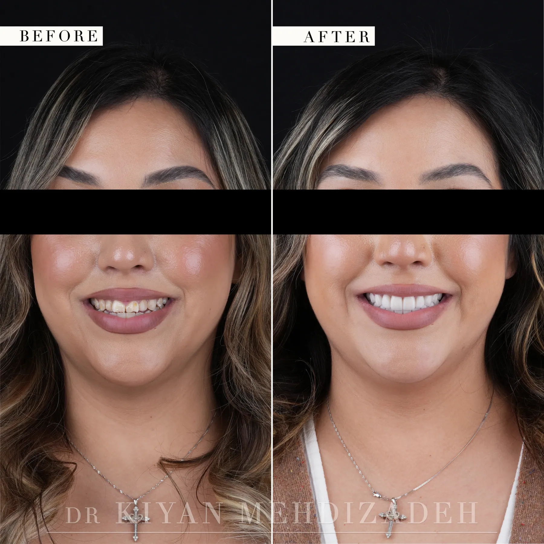 Full-face before and after, demineralization treated with porcelain veneers