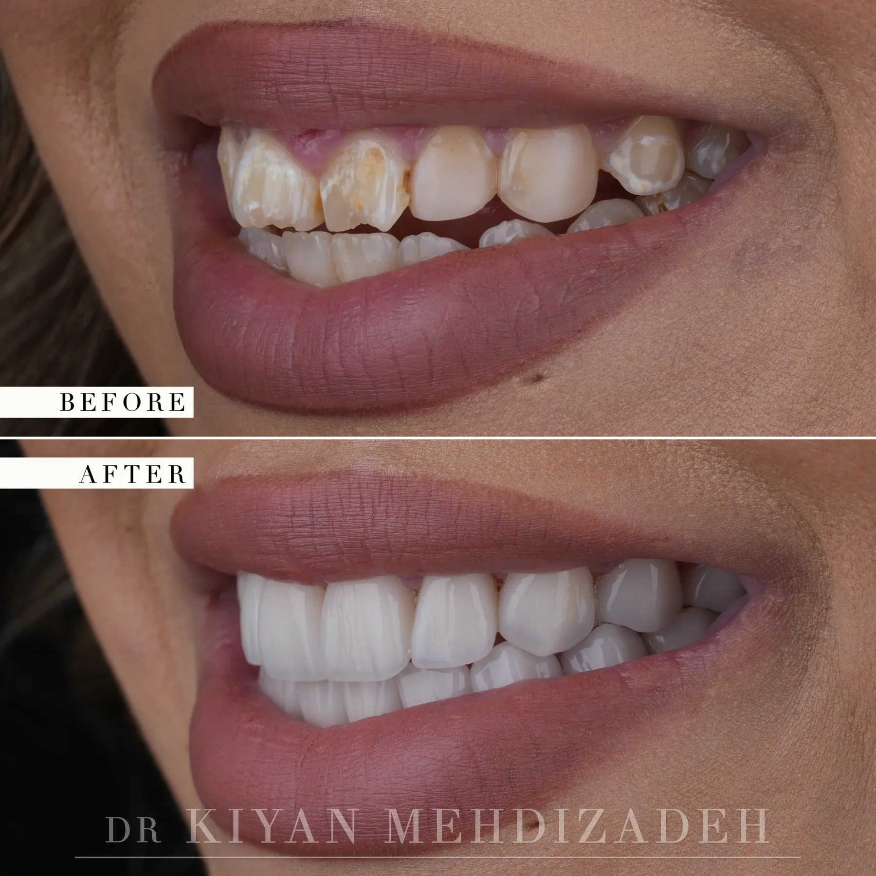 Side view of the smile after porcelain veneers treated demineralization
