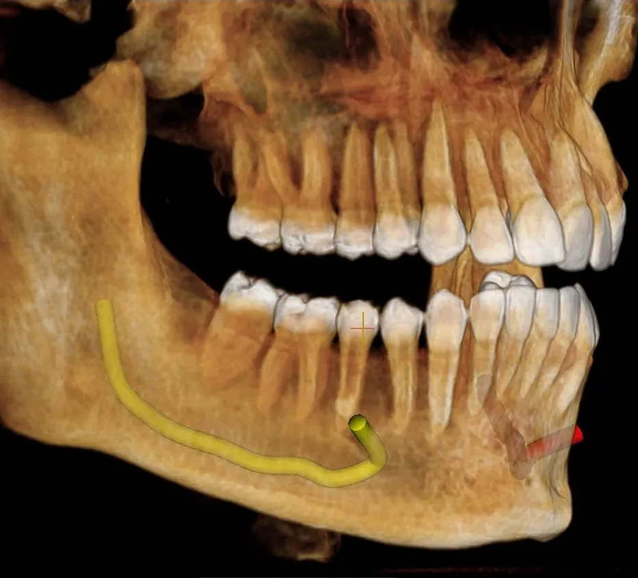 أشعة 3D (أشعة مقطعية) للفكين تُستخدم للتخطيط لخلع أضراس العقل