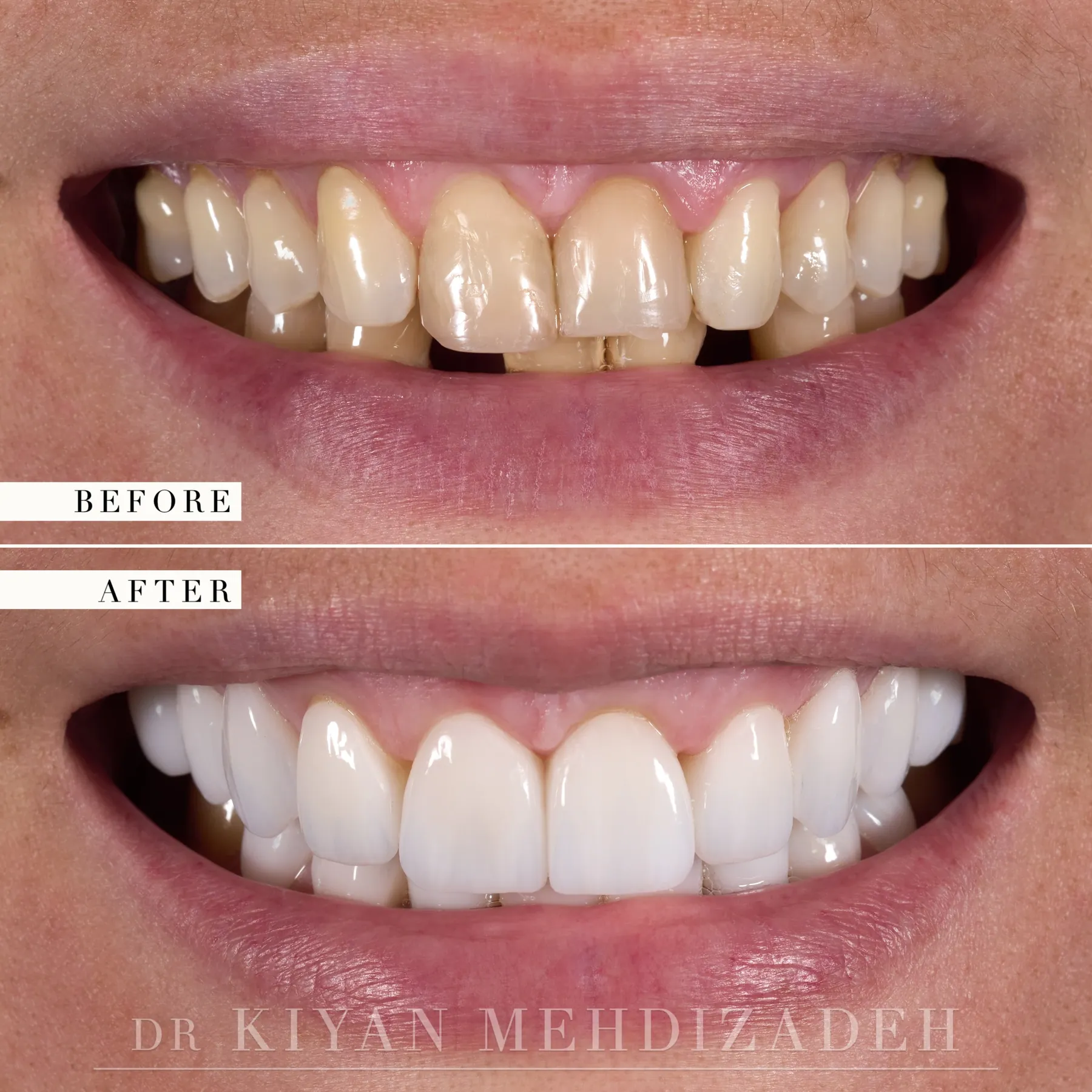 Implants, whitening and veneers before and after &mdash; Case Study 36