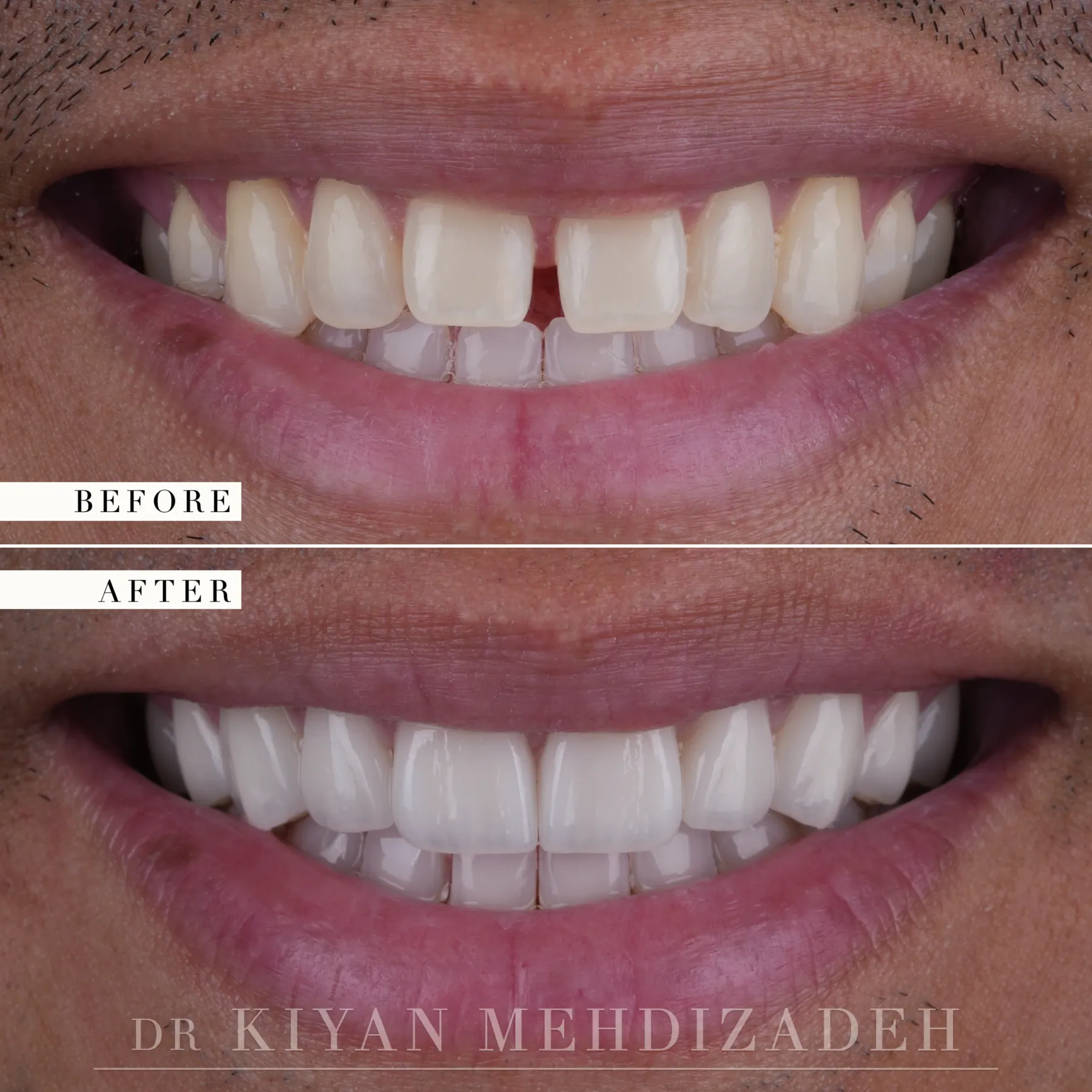 Diastema closure with porcelain veneers before and after &mdash; Case Study 06