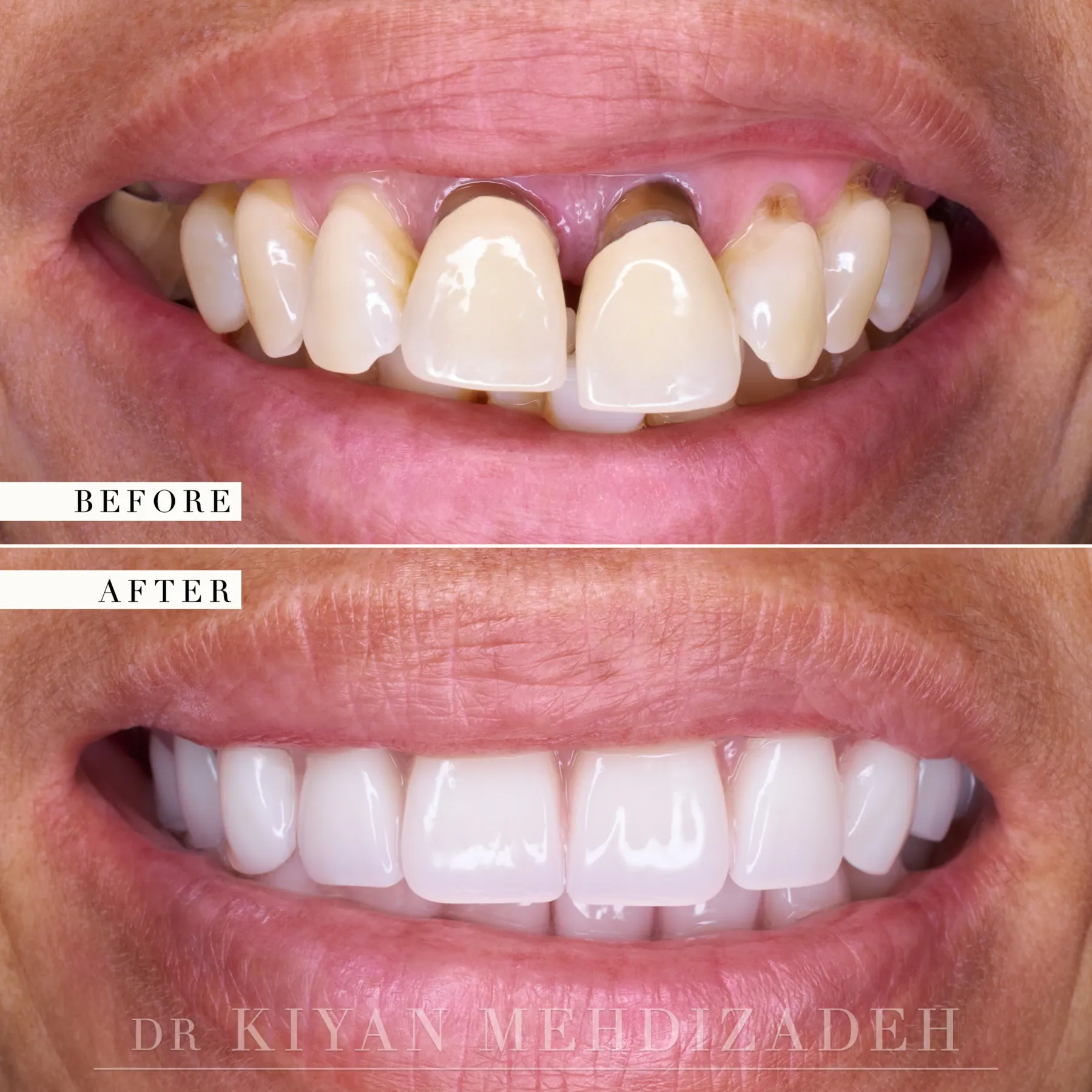 Full-arch implants after gum disease before and after &mdash; Case Study 32