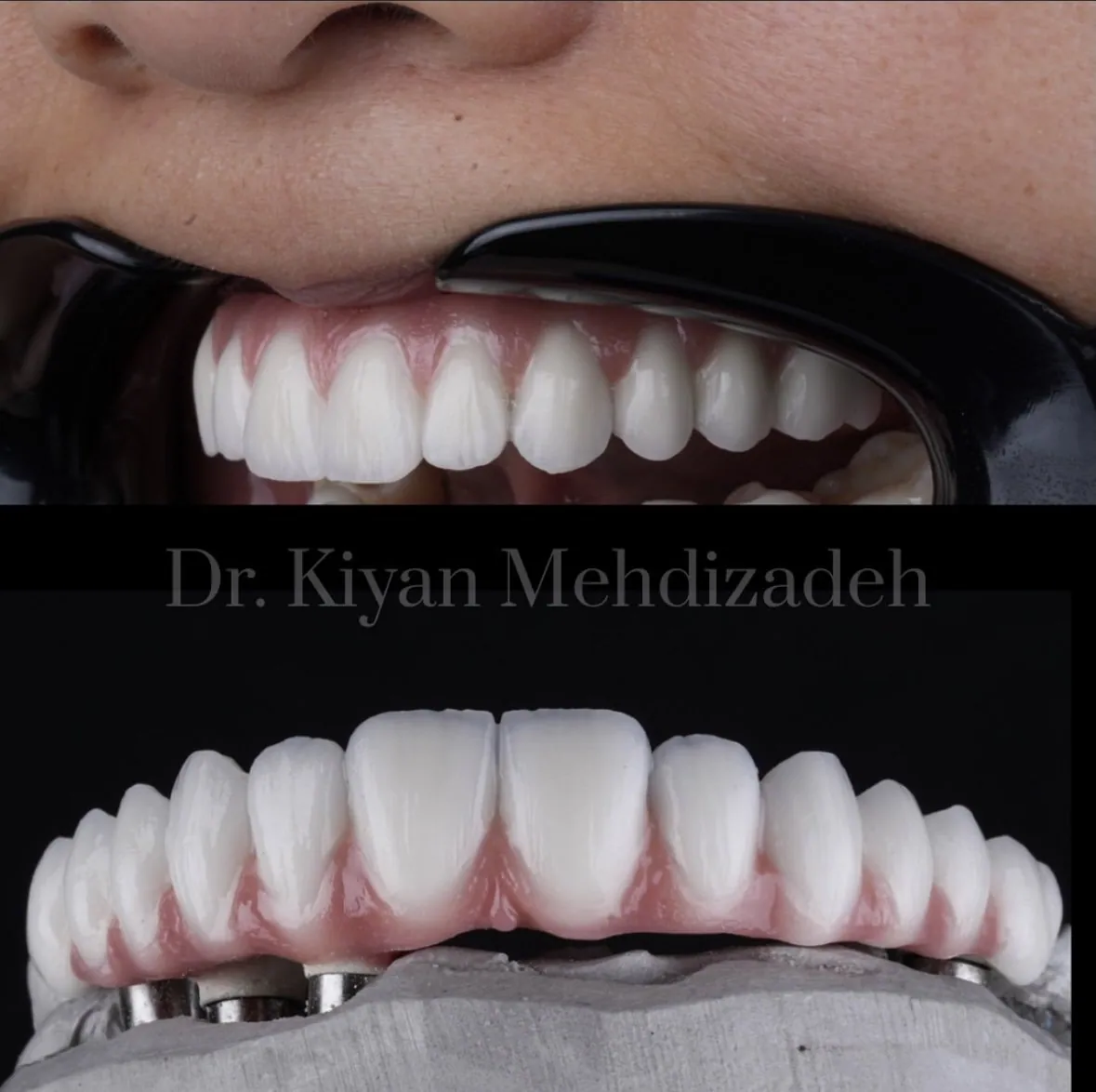 A full-arch bridge in the mouth, and the same bridge on its implant parts on the laboratory model