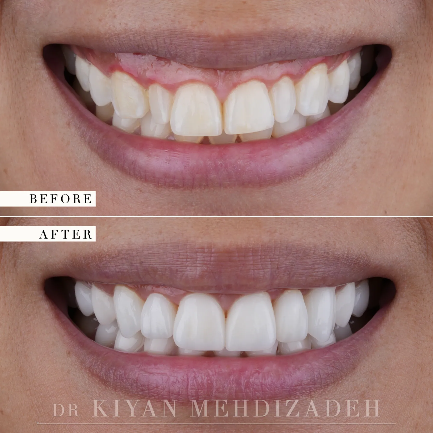 A tilted gum line leveled and twenty veneers before and after &mdash; Case Study 40