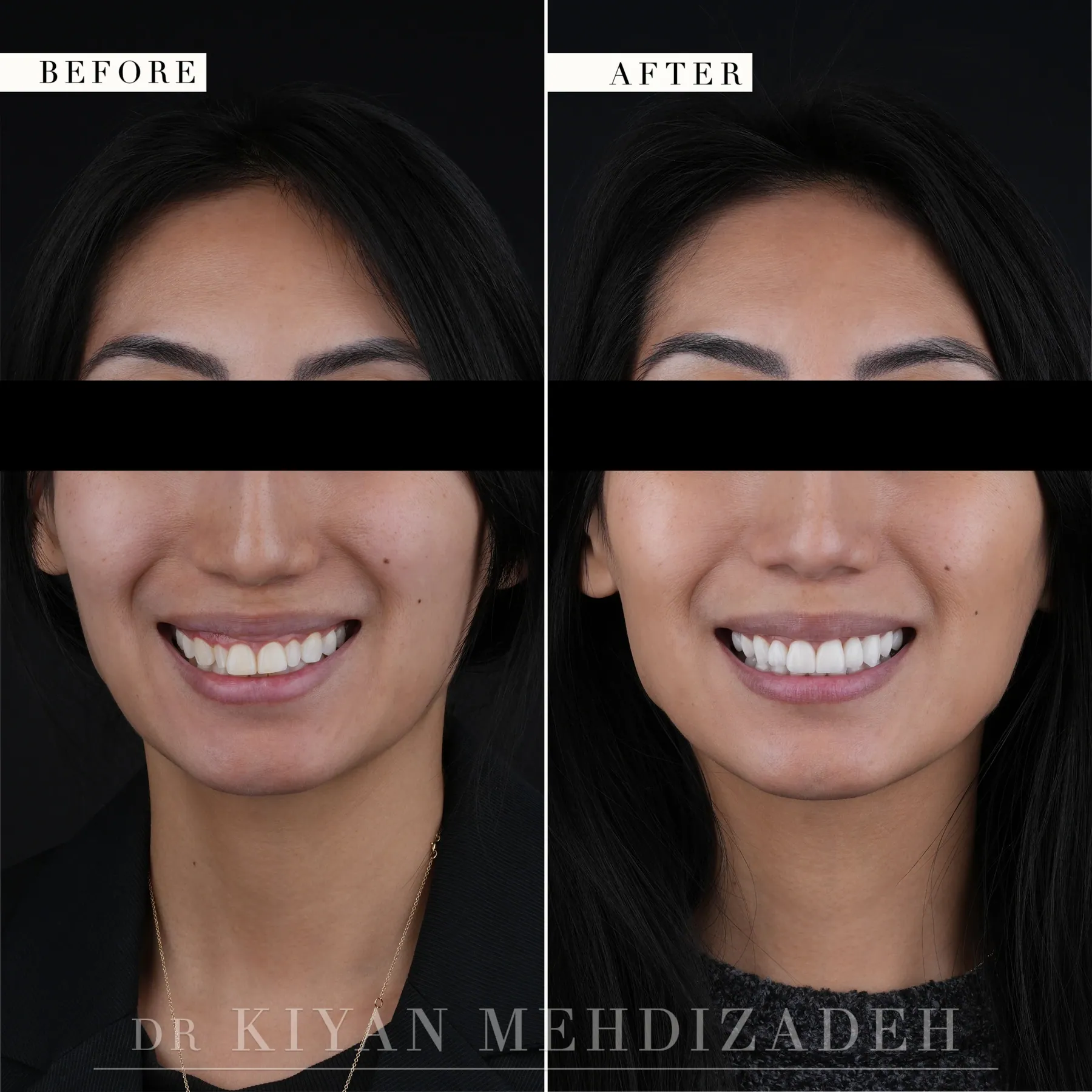 Rostro completo, antes y después: una sonrisa estrecha y decolorada reemplazada por una sonrisa uniforme y más luminosa, en proporción con el rostro, Beverly Hills