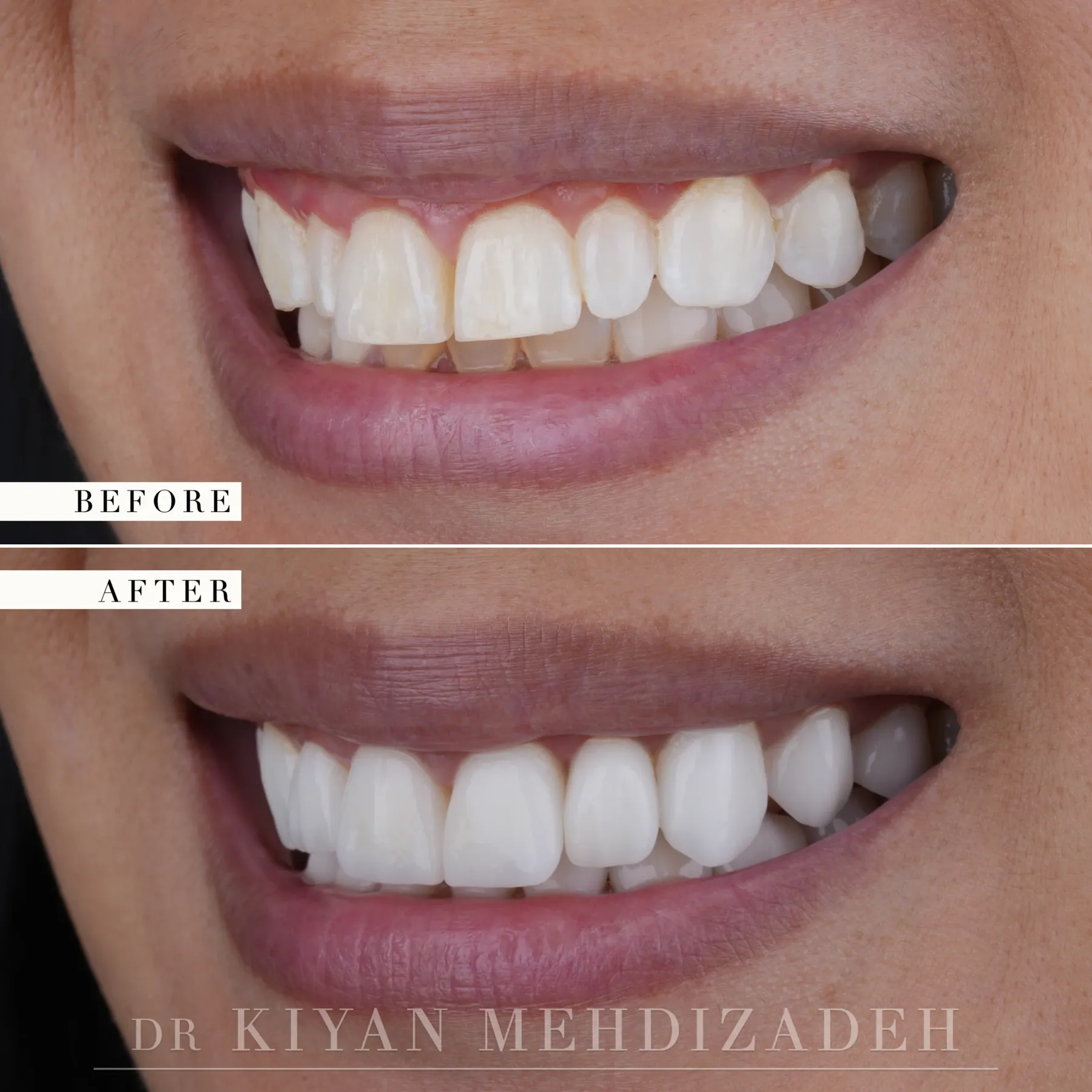 Lado izquierdo, antes y después: dientes superiores amarillentos e irregulares con encía visible, restaurados a una arcada uniforme con carillas, Beverly Hills