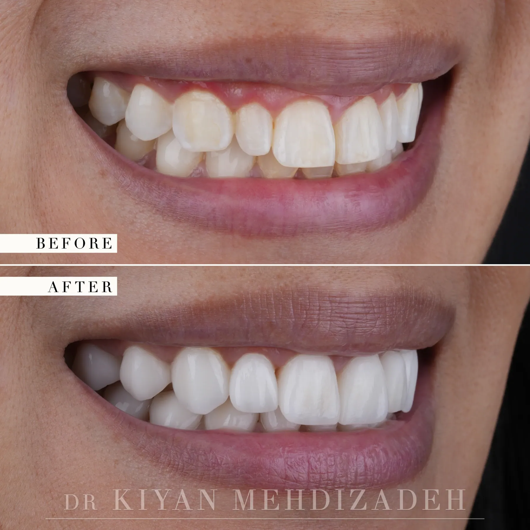 Lado derecho, antes y después: dientes superiores apiñados y decolorados con mucha encía visible, restaurados a una arcada alineada con carillas, Beverly Hills