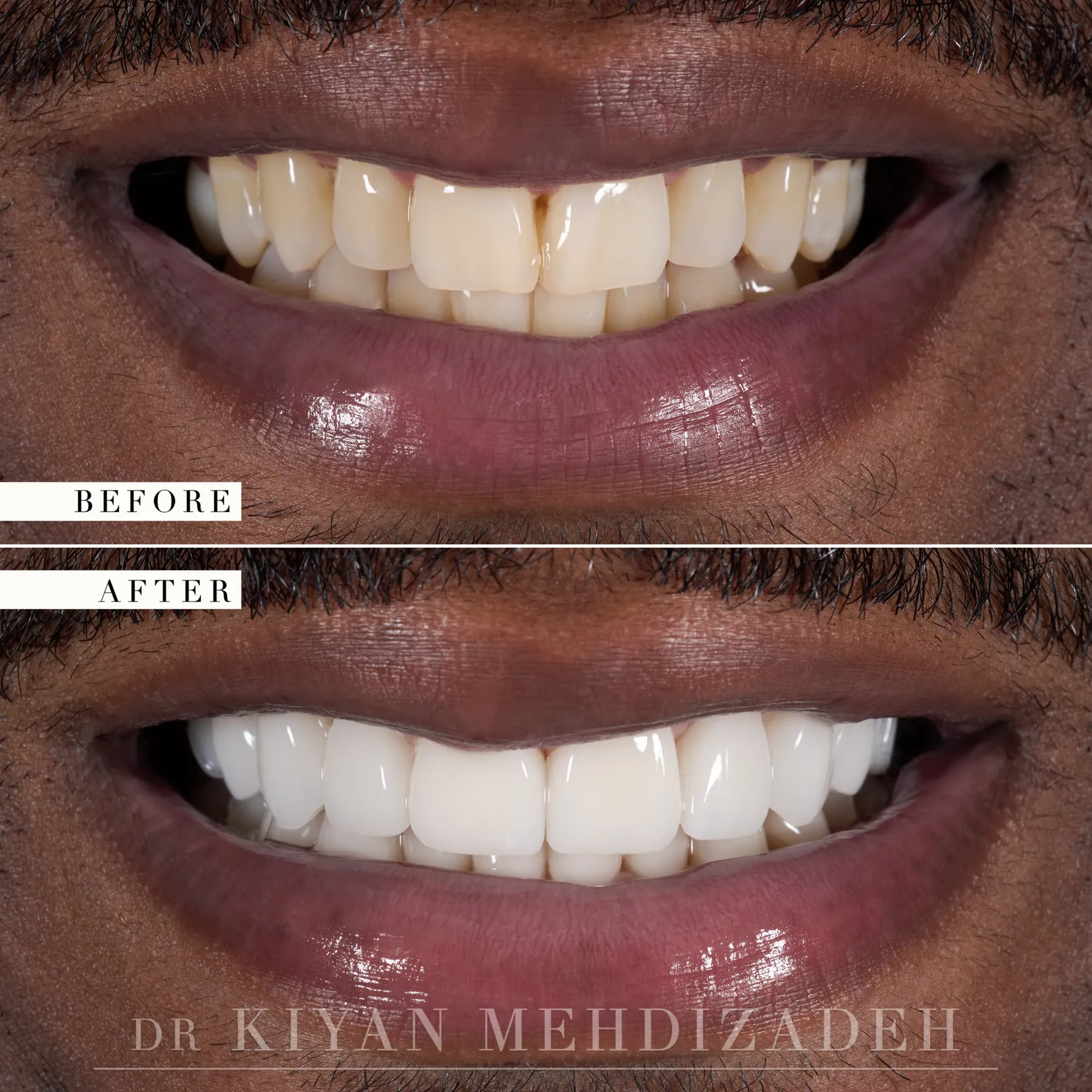 Before and after: discolored upper and lower teeth with uneven proportions and dark spaces, restored with three implant crowns and seventeen porcelain veneers, Beverly Hills