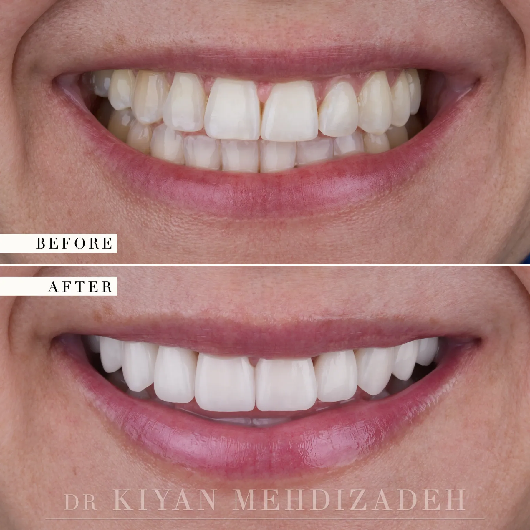 Midline correction with ten veneers before and after &mdash; Case Study 43