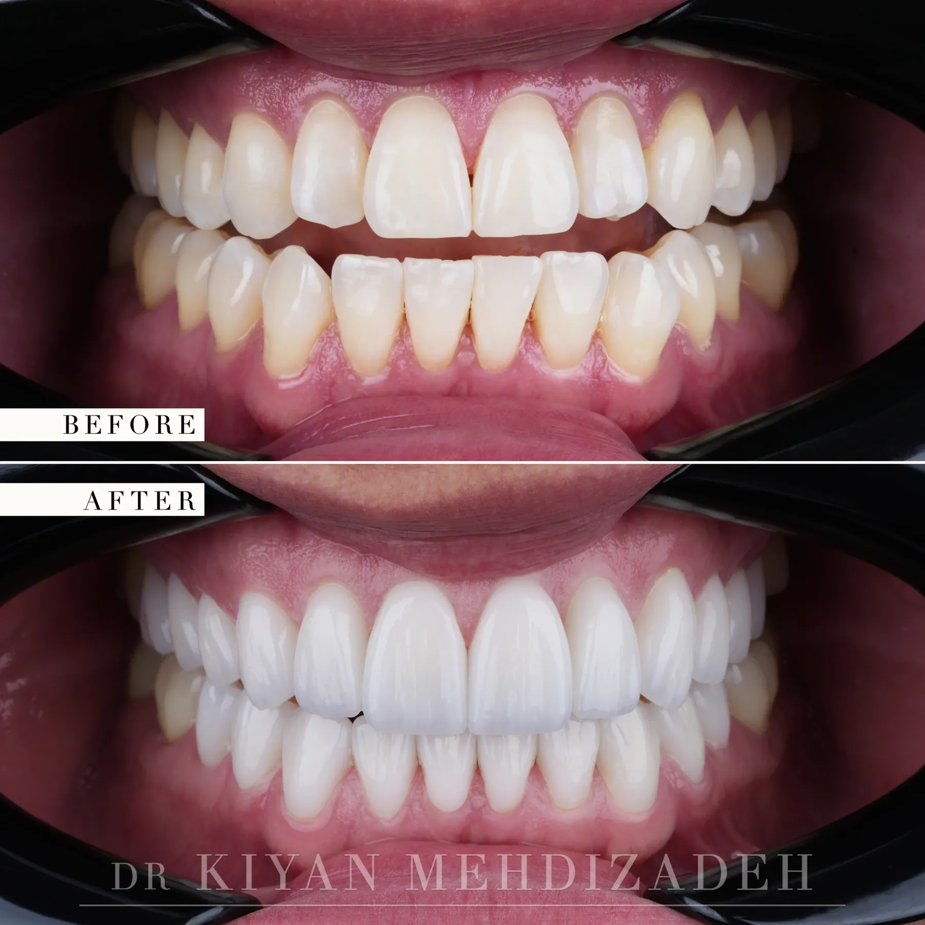 Full mouth porcelain veneers before and after &mdash; Case Study 17