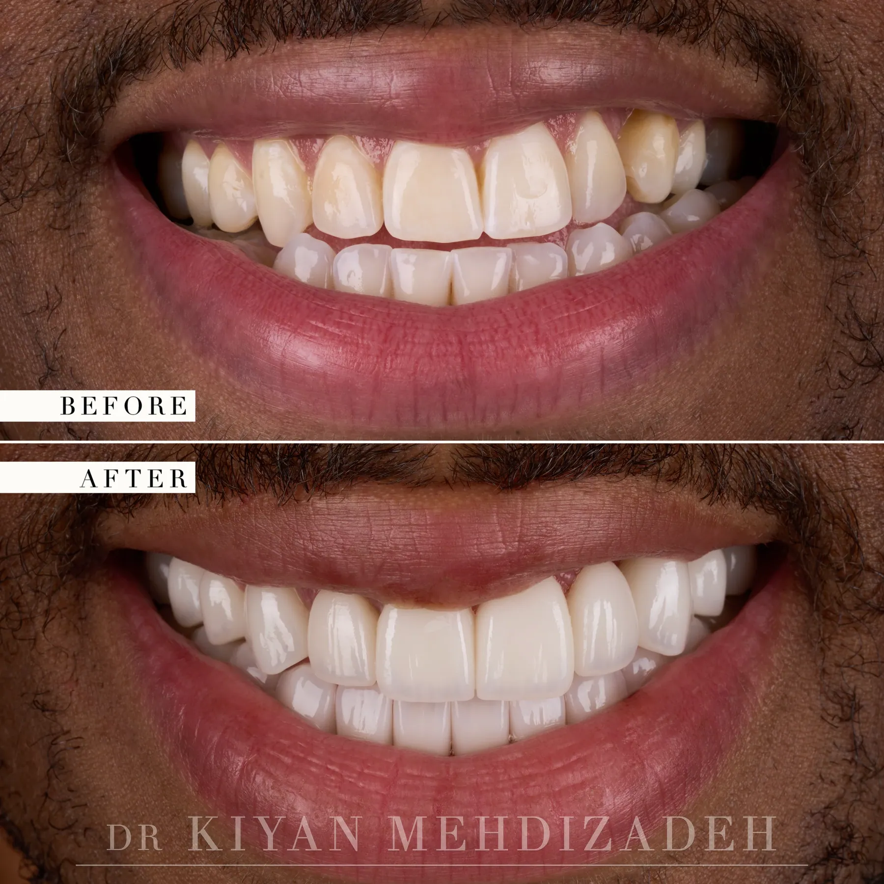 Underbite Correction: Full-Mouth Veneers before and after - Case Study 21 - Kiyan Mehdizadeh, DMD
