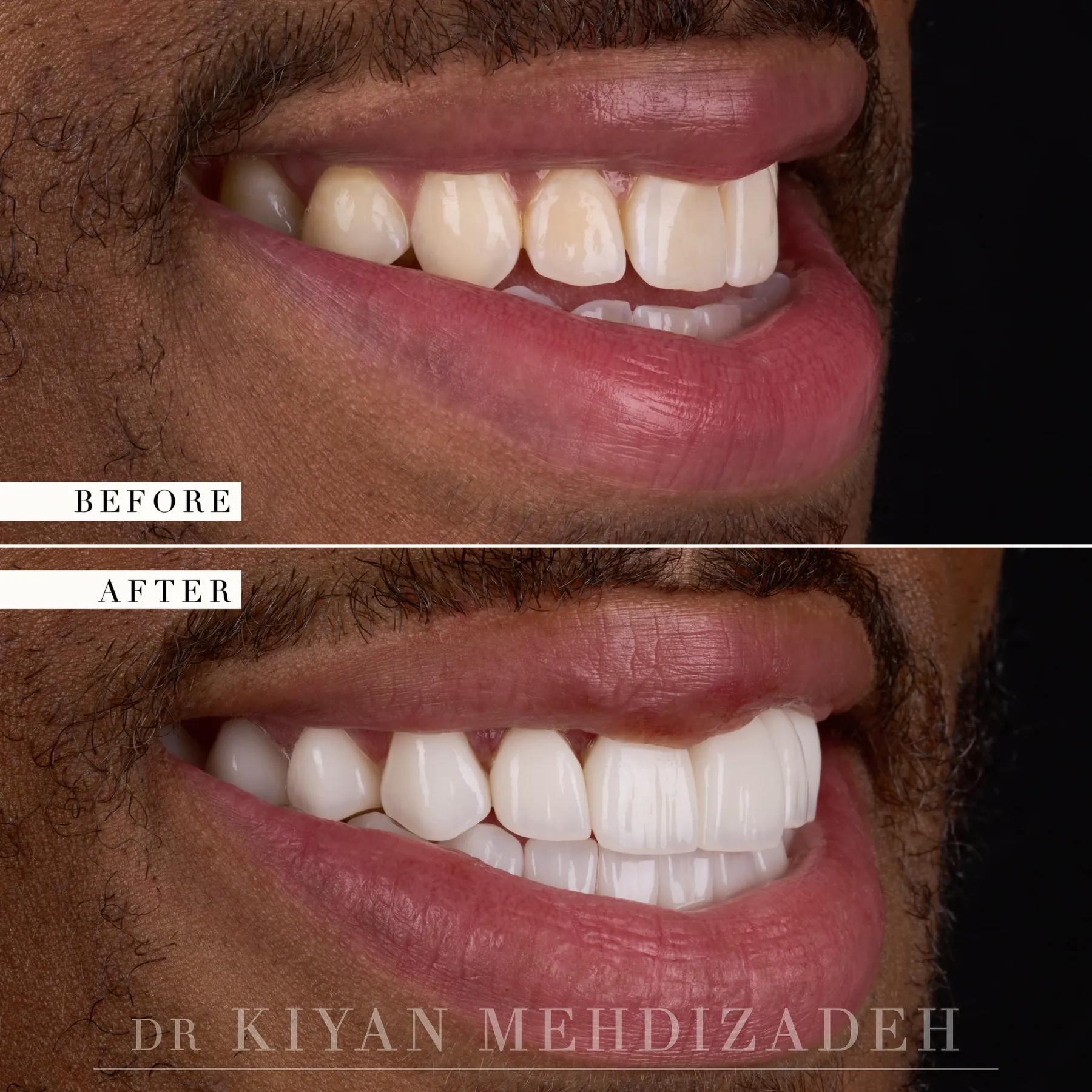 منظر جانبي بعد أن أعاد فينير الفم بالكامل بناء الإطباق