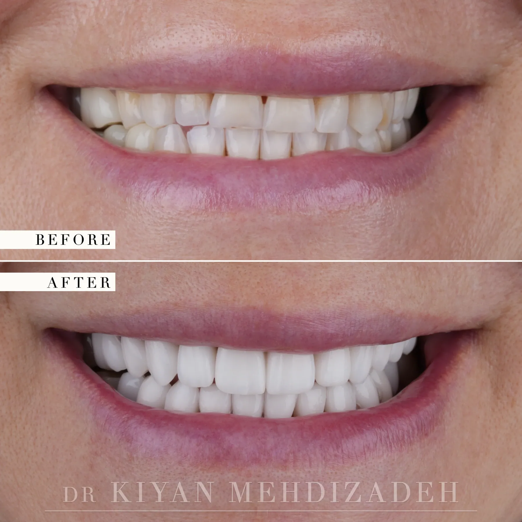 Length restored to worn teeth before and after &mdash; Case Study 45
