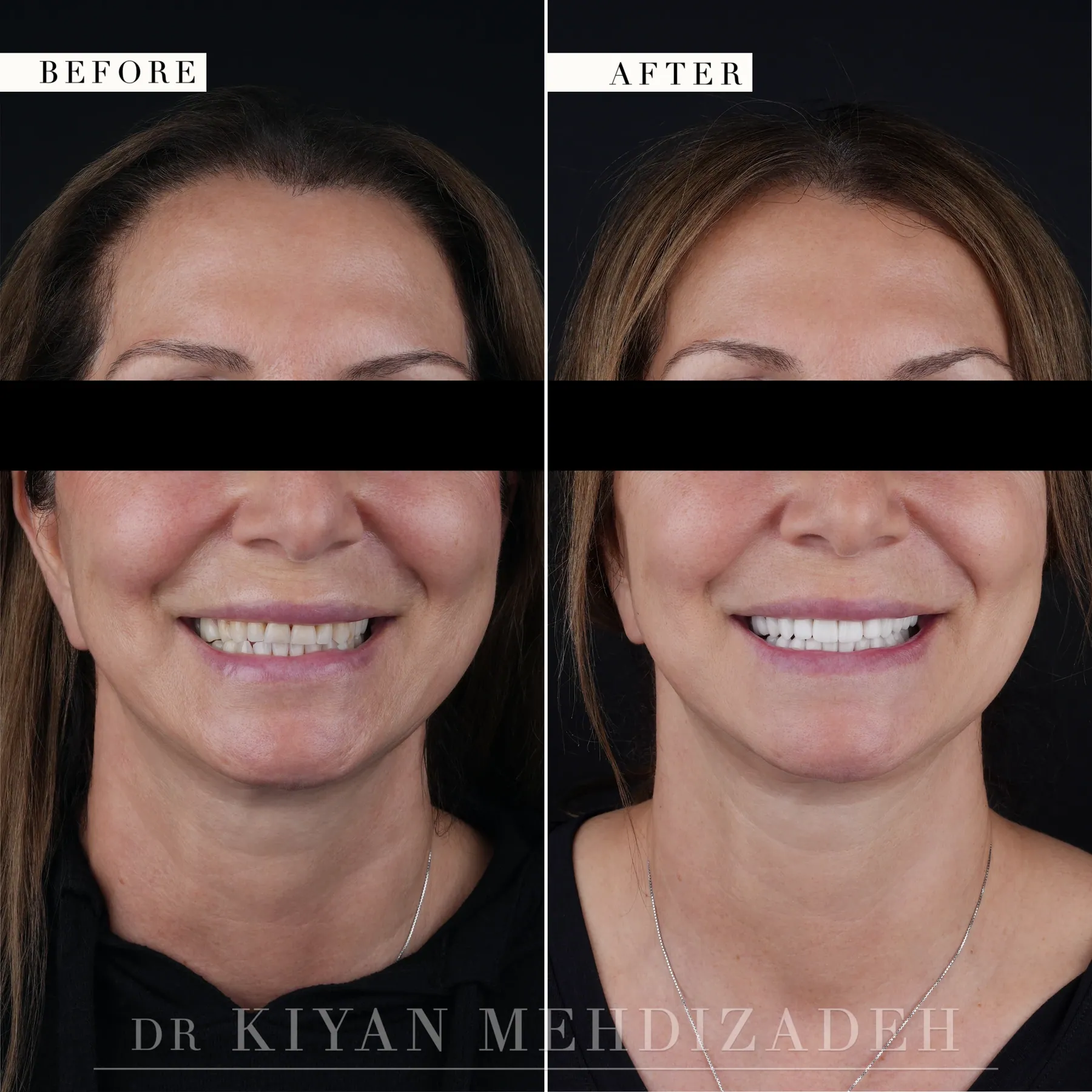 Rostro completo, antes y después: una sonrisa acortada y decolorada restaurada a un largo más pleno y un tono más luminoso, Beverly Hills