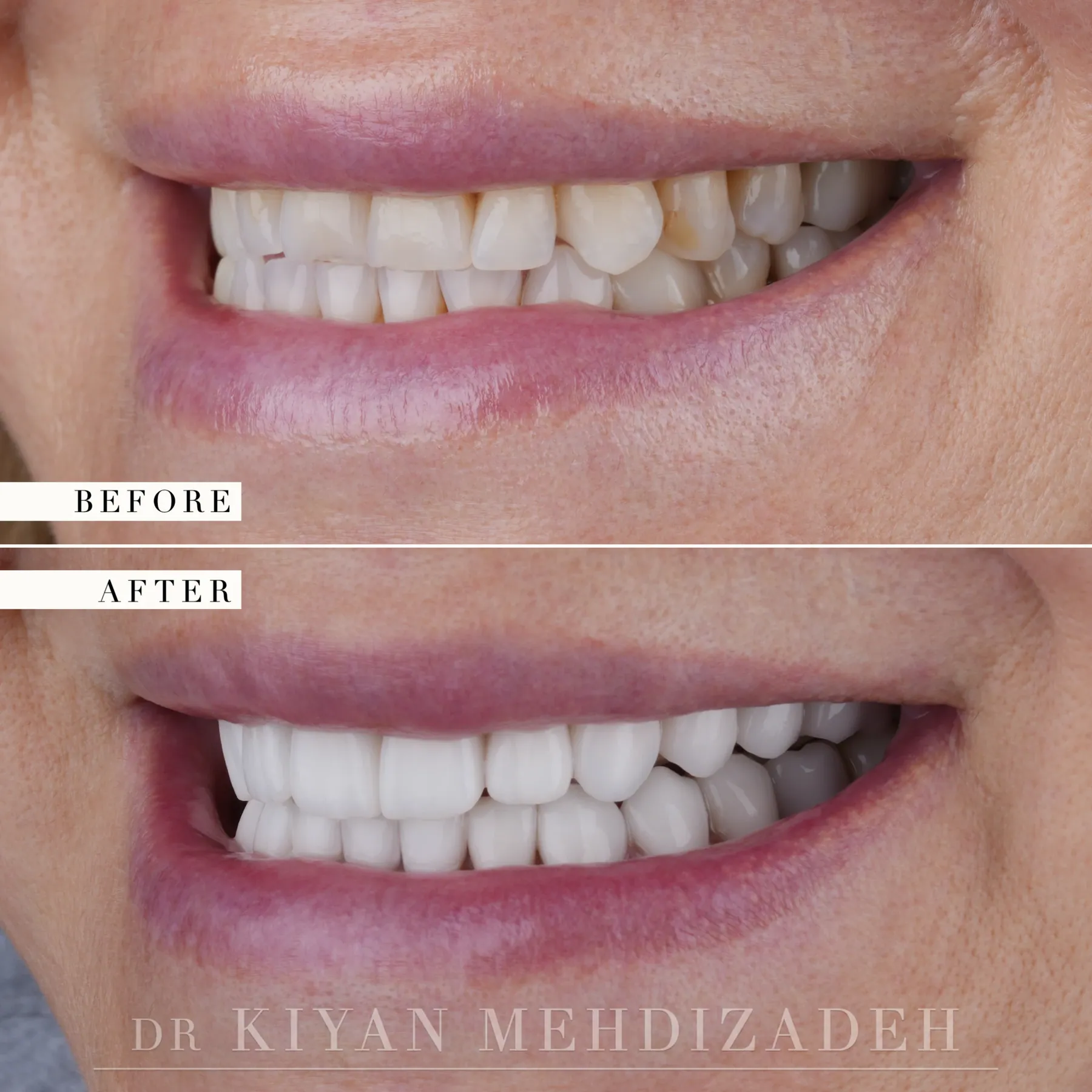 Lado izquierdo, antes y después: bordes incisales aplanados y dientes posteriores amarillentos restaurados a su largo completo en porcelana uniforme, Beverly Hills