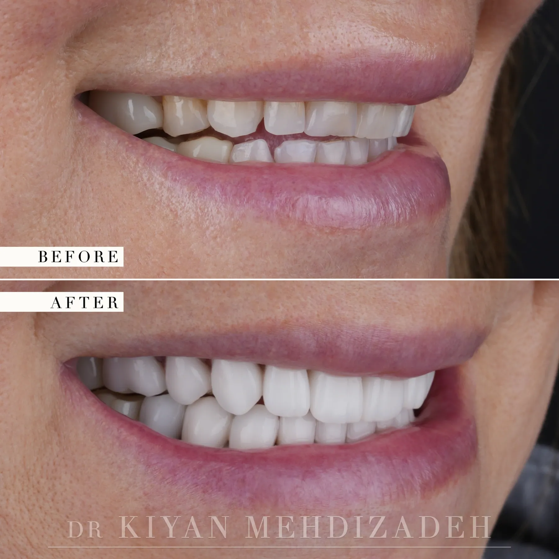 Lado derecho, antes y después: dientes cortos y desgastados con un corredor bucal oscuro restaurados a una arcada con carillas más larga y luminosa, Beverly Hills