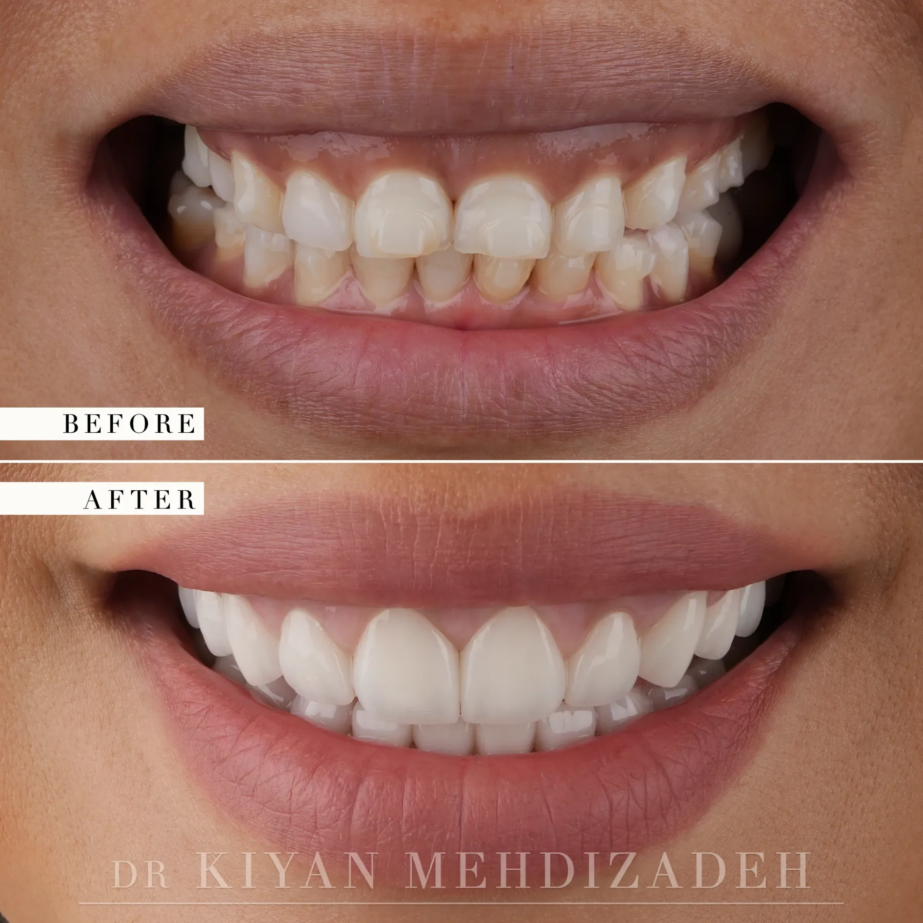 Gum lift and porcelain veneers before and after &mdash; Case Study 01 &mdash; Kiyan Mehdizadeh, DMD