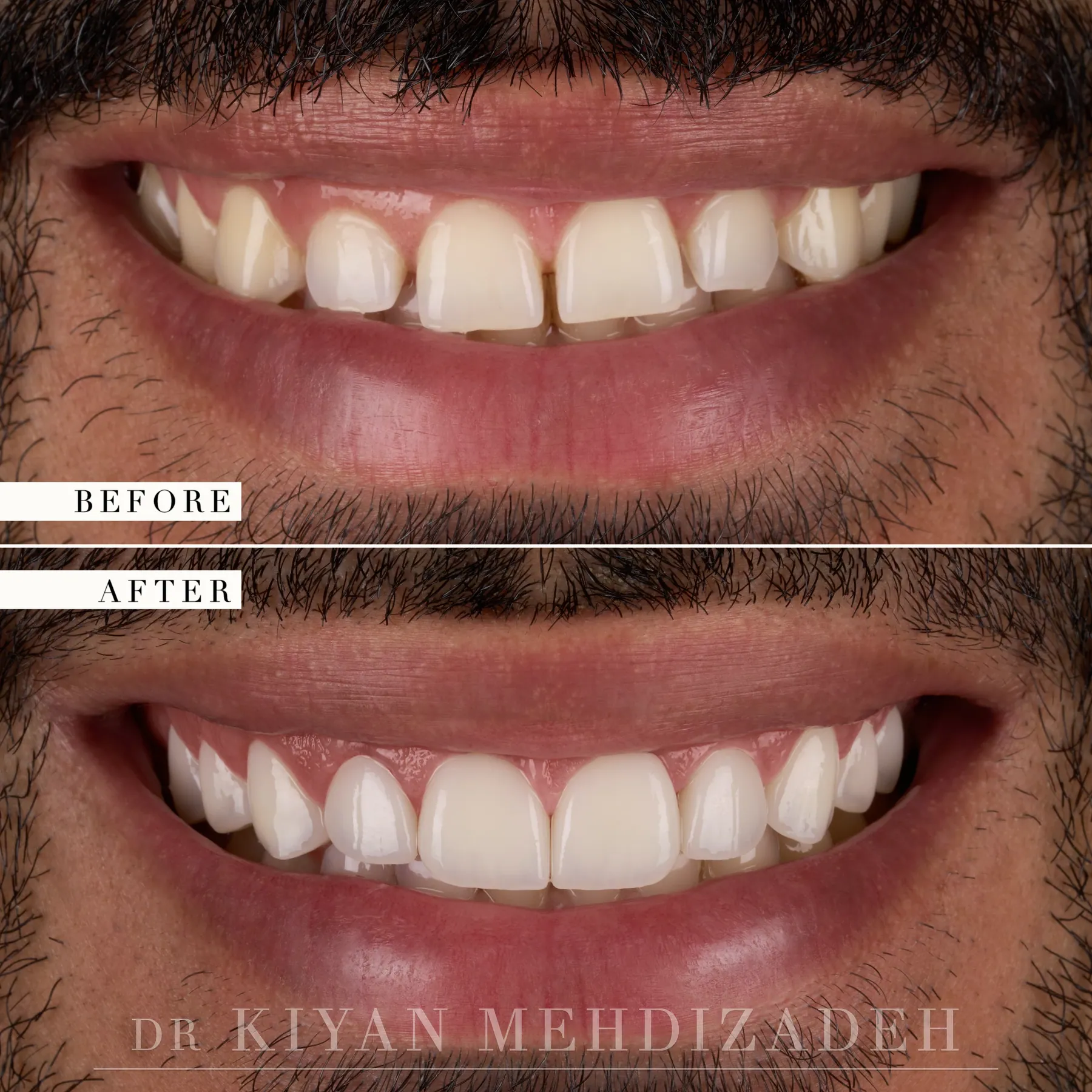Crown Lengthening & Veneers before and after - Case Study 20 - Kiyan Mehdizadeh, DMD