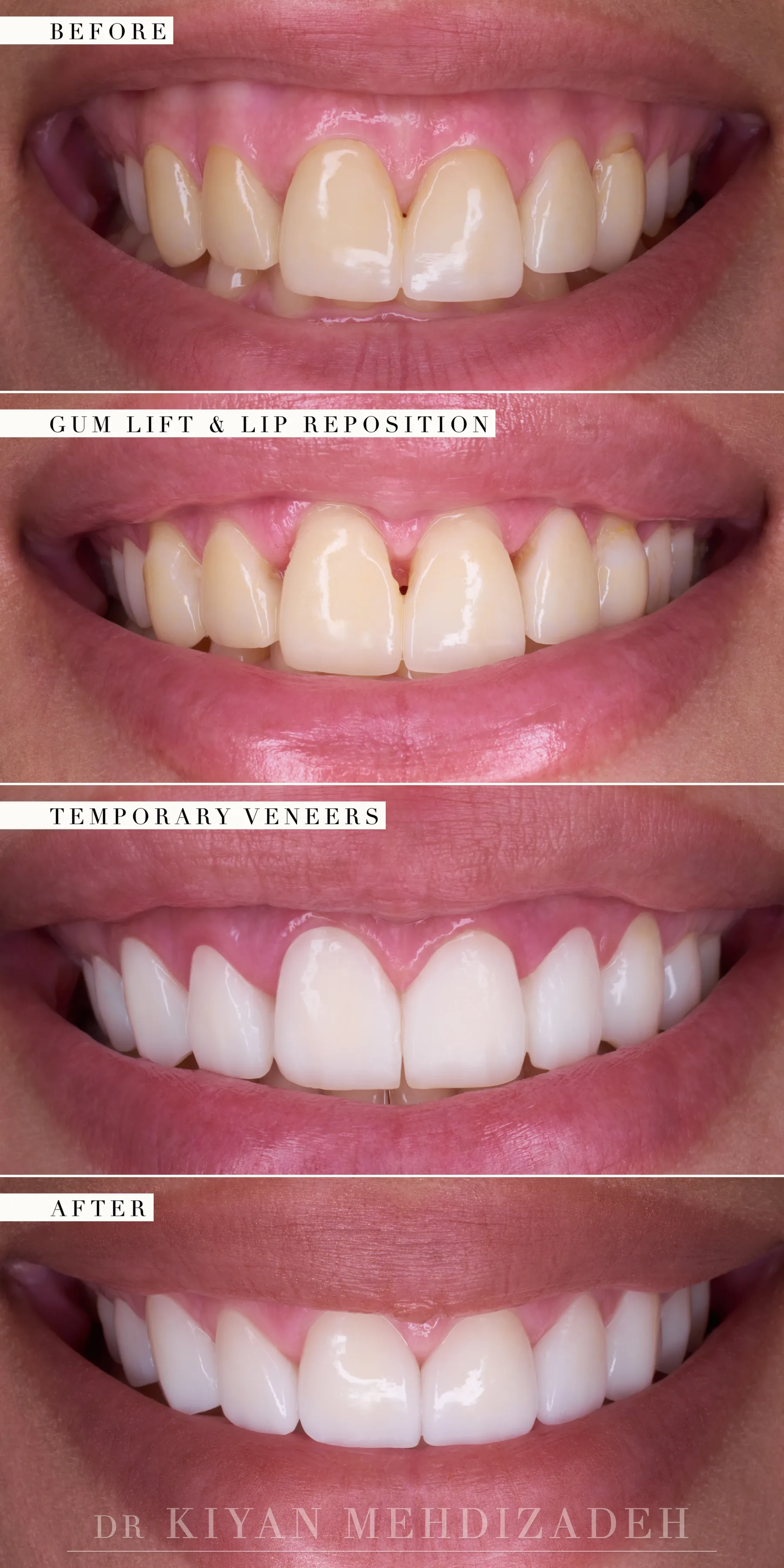 Every stage of the gummy smile revision, from the original veneers to the final e.max veneers