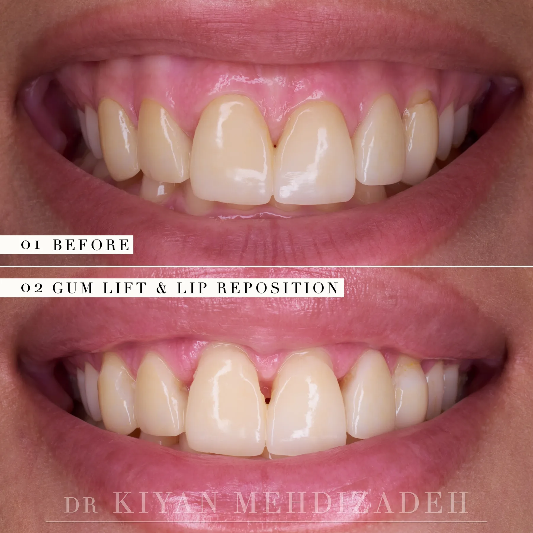 The gum line after crown lengthening and lip repositioning, before the new veneers