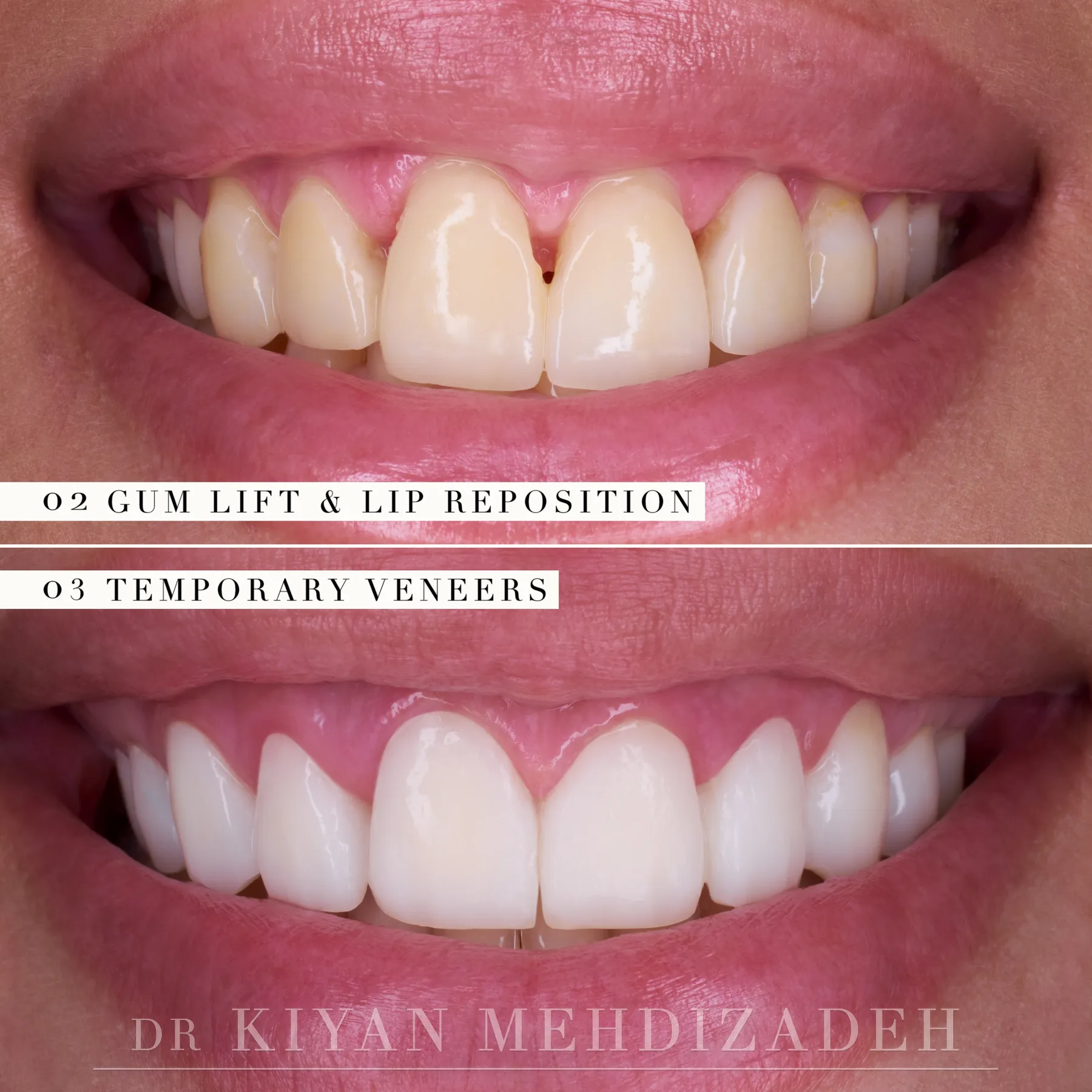 Temporary veneers in the new, shorter smile design