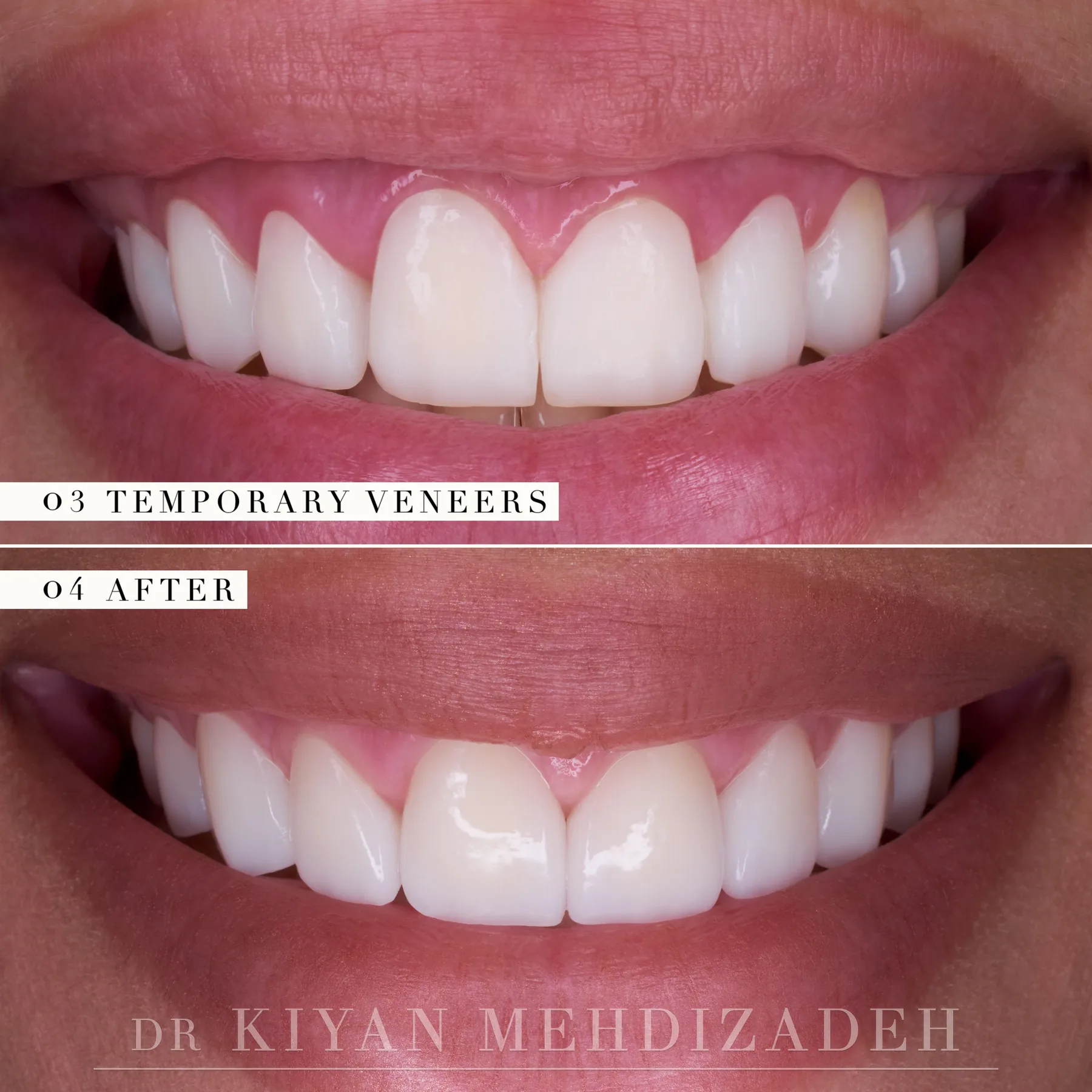 Temporary veneers in the new, shorter design, and the final e.max veneers copied from them