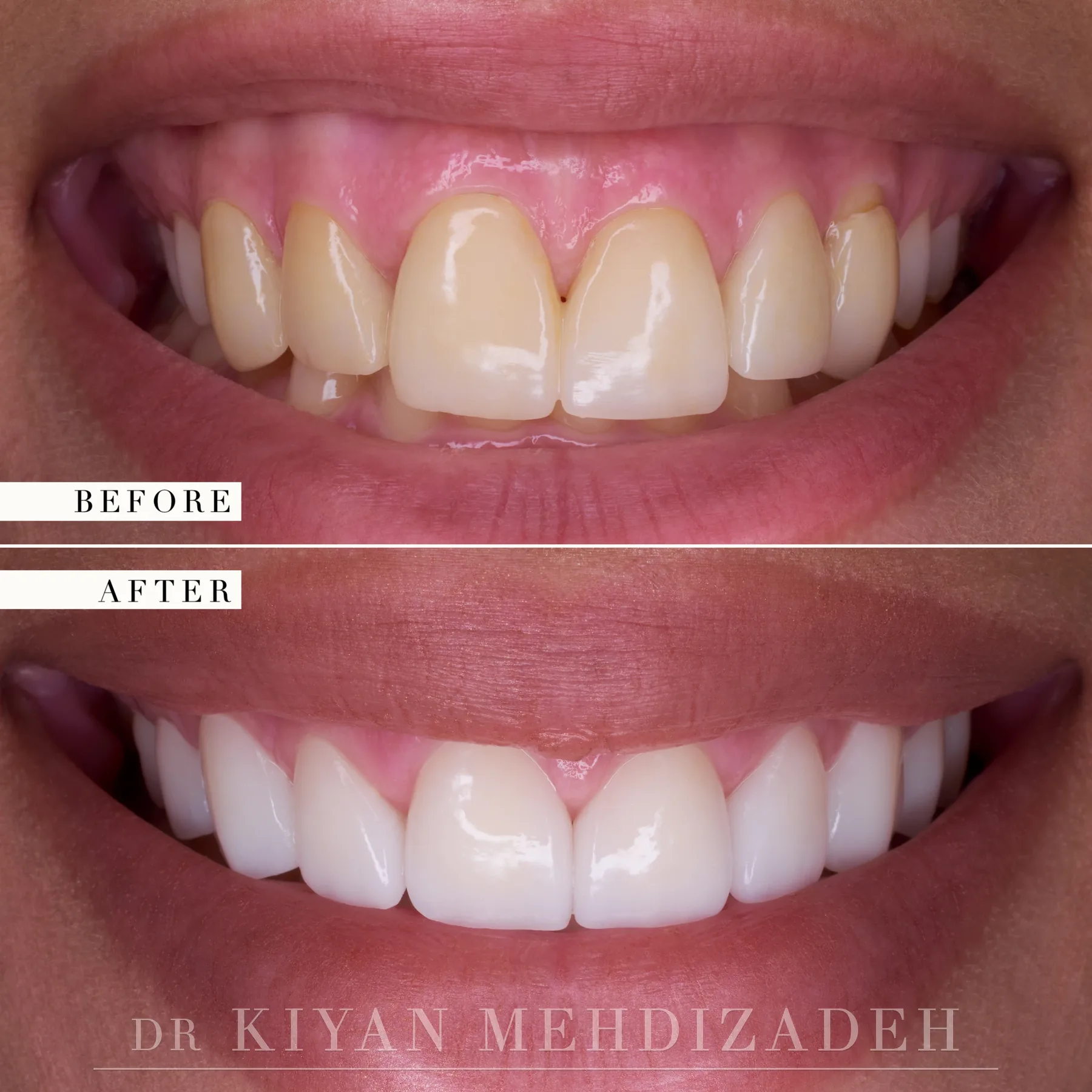 Before and after: a gummy smile with overlong veneers corrected with crown lengthening, lip repositioning and ten e.max veneers, Beverly Hills