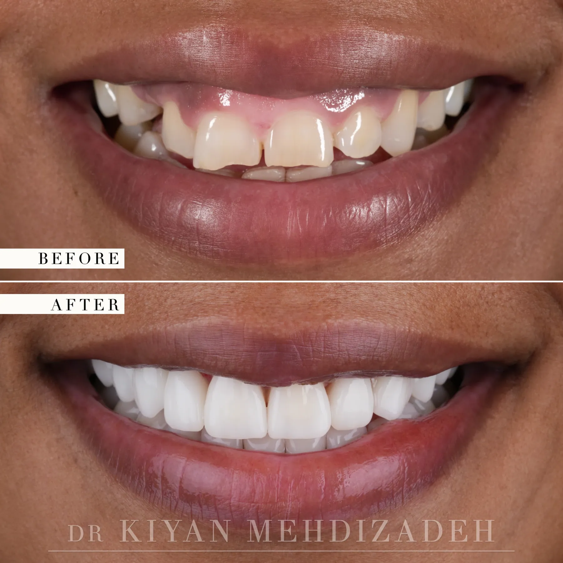Impacted canine, gum lift and veneers before and after &mdash; Case Study 37
