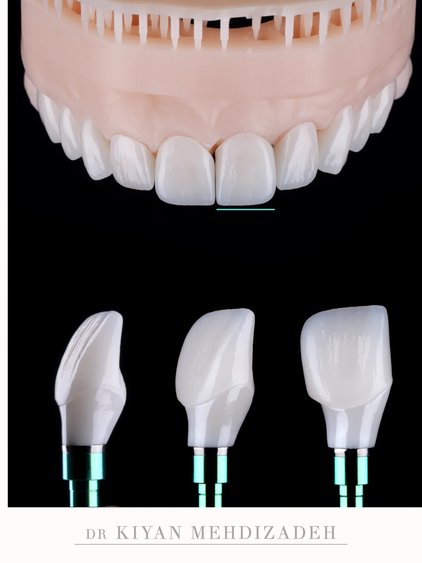 An implant crown and veneers on the laboratory model, made in our laboratory