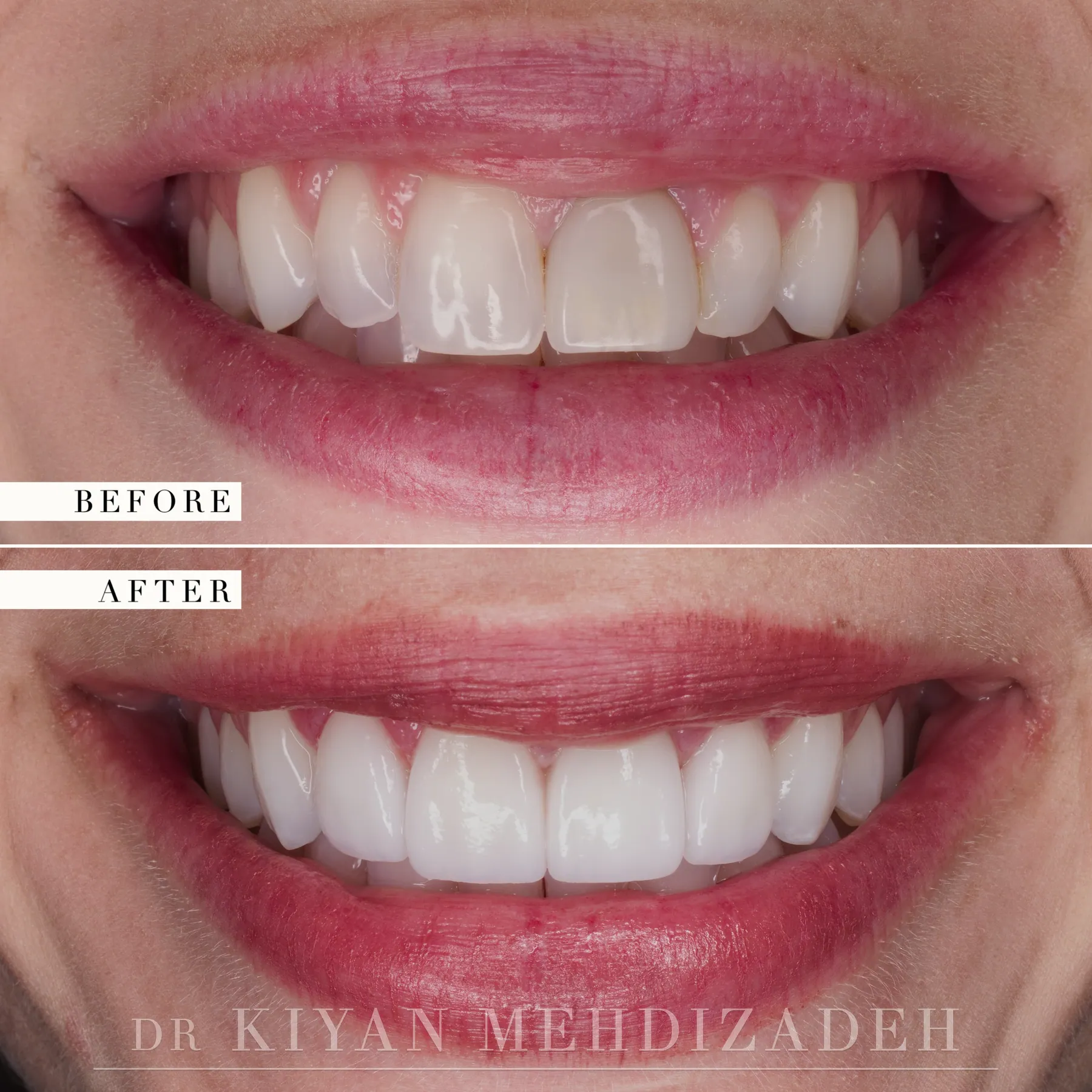 Internal bleaching and veneers before and after &mdash; Case Study 04