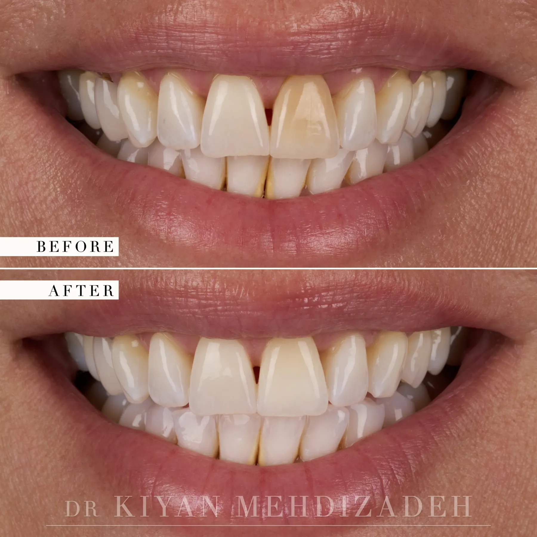 Discolored Tooth: Internal Bleaching before and after - Case Study 23 - Kiyan Mehdizadeh, DMD
