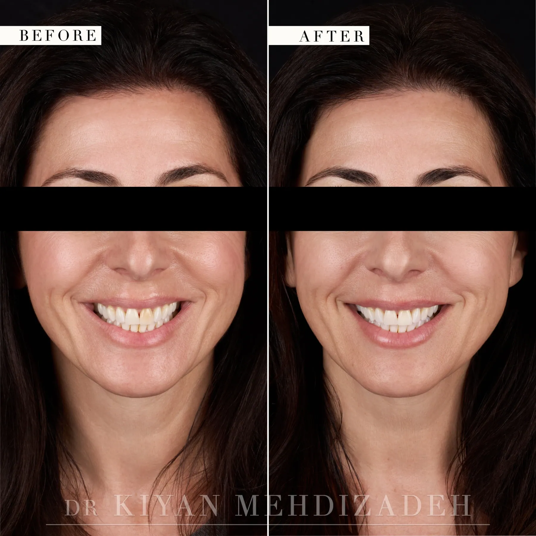 Retrato de rostro completo después de que el blanqueamiento interno uniformara un solo diente oscuro, Beverly Hills