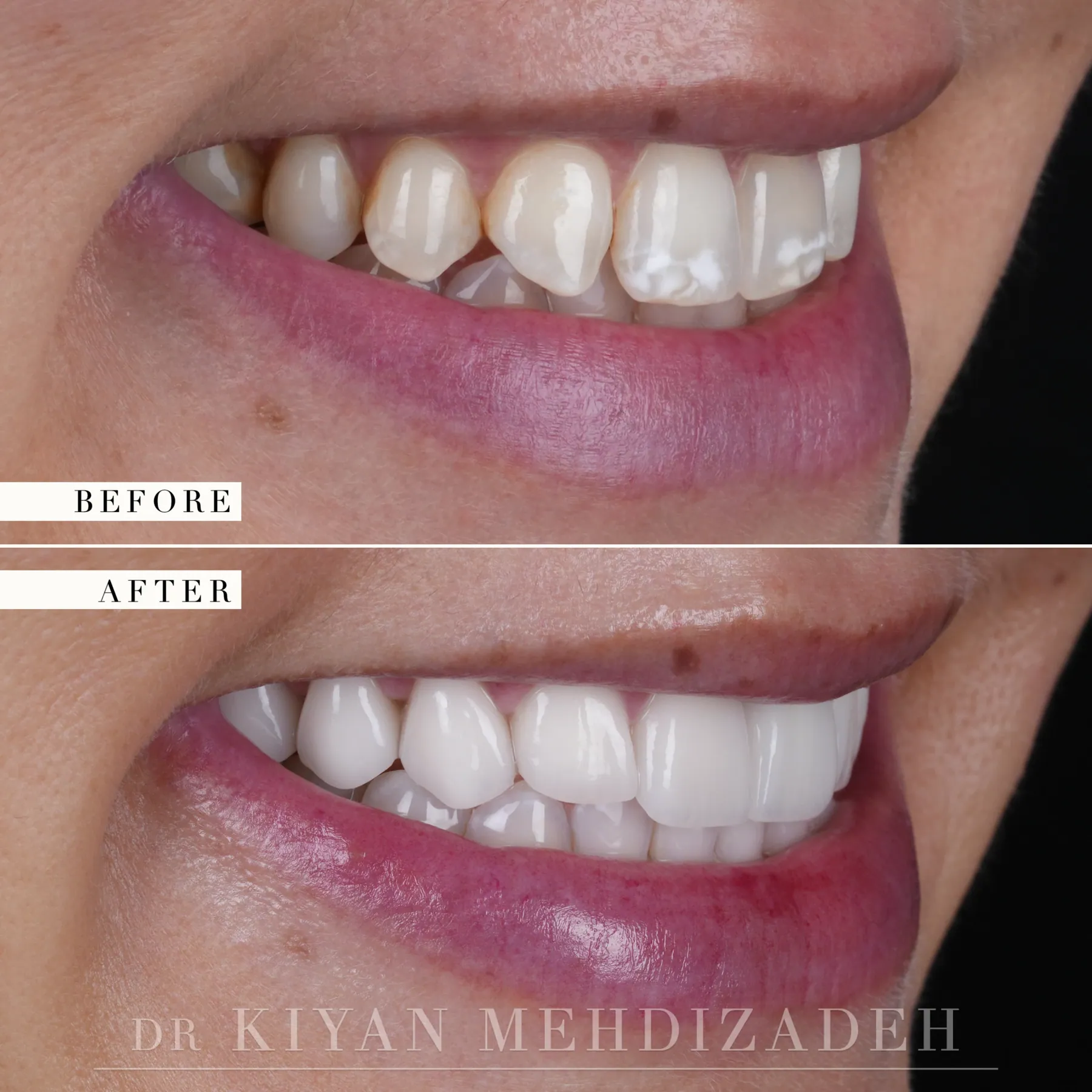 Right side view of the smile, before and after partial extraction therapy, an implant and porcelain veneers, Beverly Hills