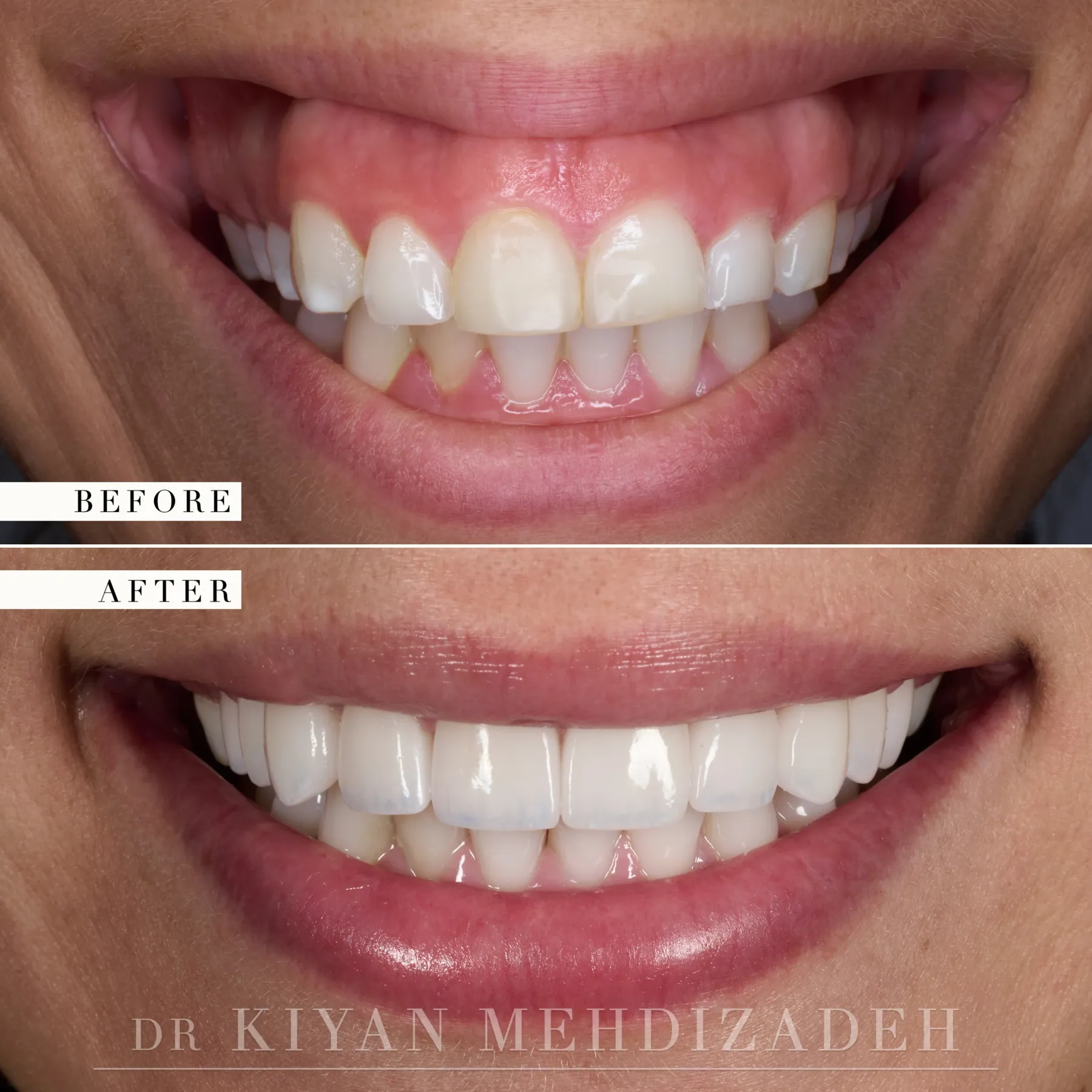 Gummy Smile: Lip Repositioning & Gum Lift before and after - Case Study 29 - Kiyan Mehdizadeh, DMD