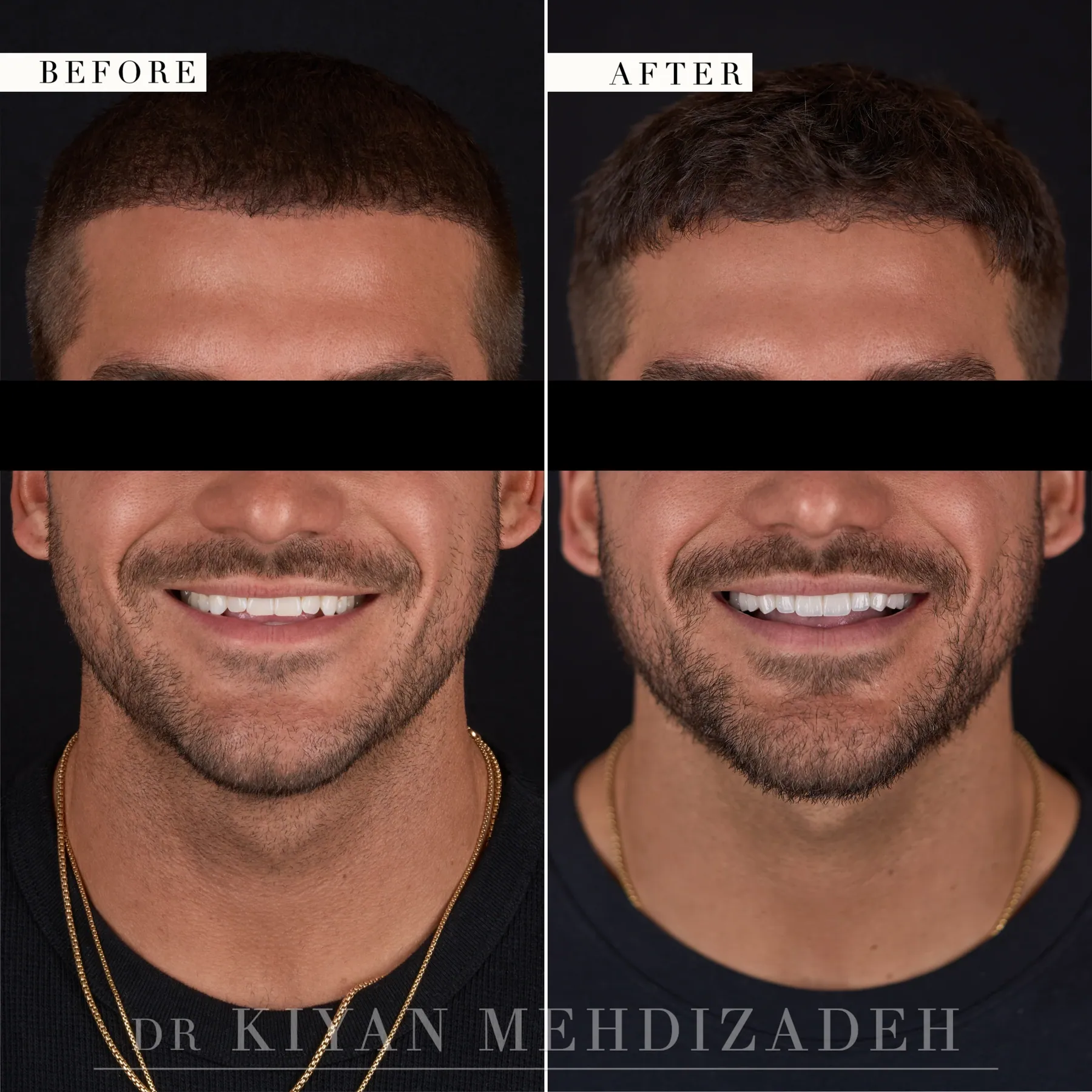 Chipped Teeth: Masculine Veneers before and after - Case Study 24 - Kiyan Mehdizadeh, DMD